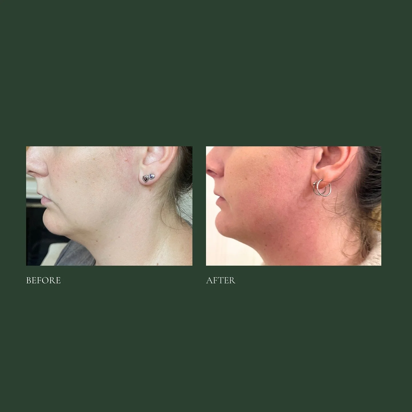 ✨ Lower Face Lift - No Filler. No Needles. No Downtime. ✨

We&rsquo;re known for our body treatment results - but what many don&rsquo;t realise is that we also offer gentle, non-invasive treatments for the face, jawline, and neck, using the same care