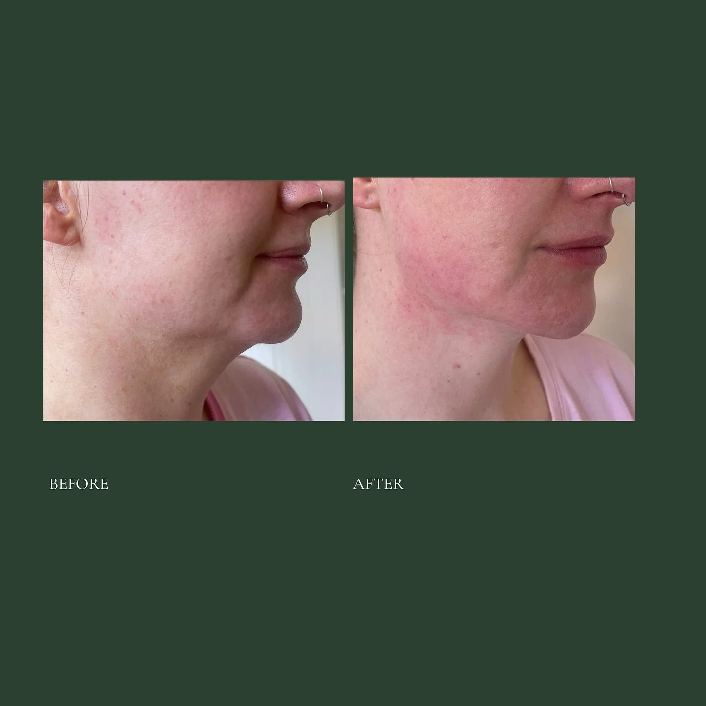 For the women who want to look like themselves, just fresher. No needles, no filler, no pain. Just real results that work with your body, not against it.

This is our lower facelift, jaw and neck contouring treatment. It lifts, defines and sculpts us