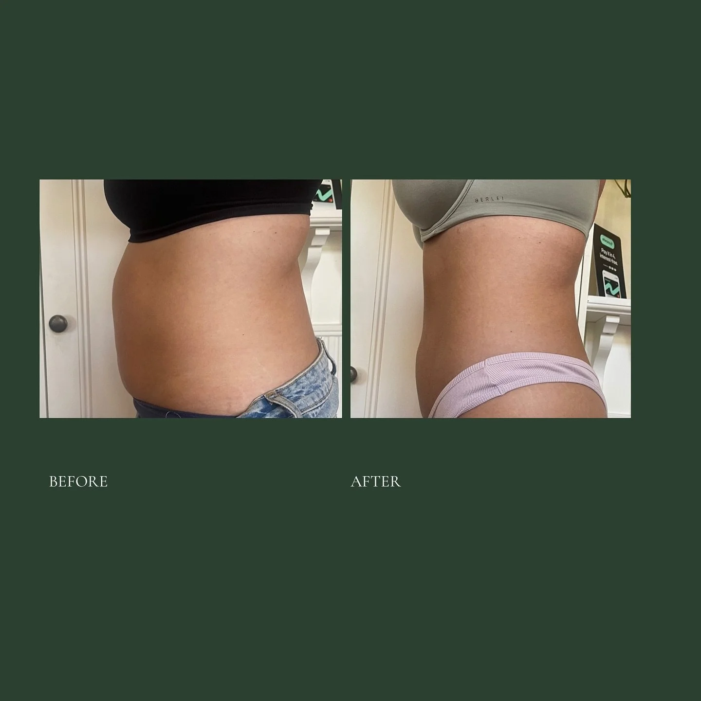 With 👏 no 👏 other 👏 change 👏 to 👏 lifestyle..
This is what happens when you address fluid retention, inflammation, and finally activate the deep muscle layers that help hold and shape your natural contours.

So many clients are shocked when they