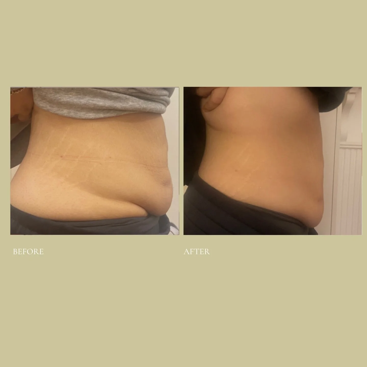 Weight loss is hard work. But, sometimes stubborn pockets can remain, even when you&rsquo;re doing everything right.

This client had already been on her weight loss journey. We focused on helping her refine the final areas using targeted fat cavitat