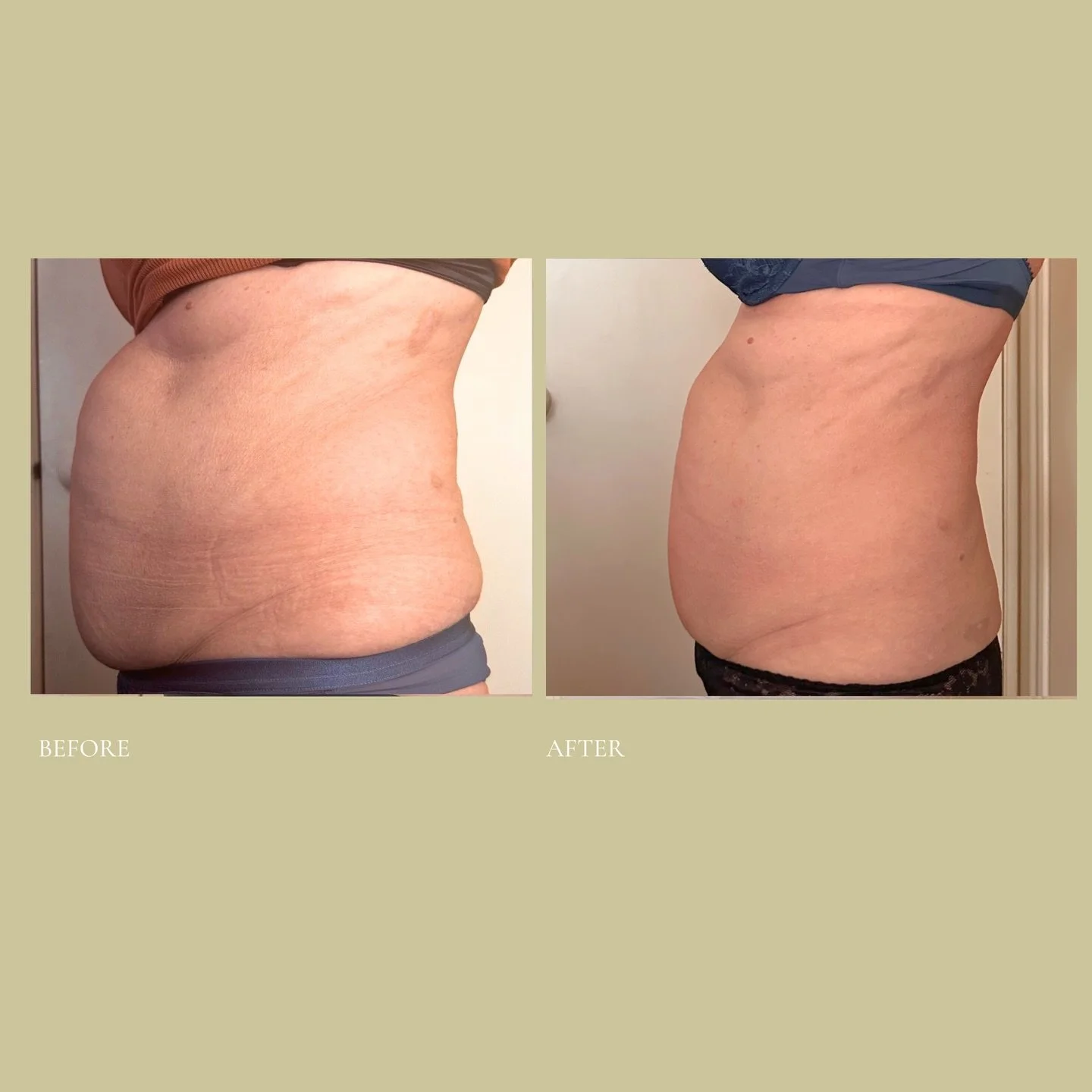 Results like this are gently created through the signature Cleanse and Shape method, an exclusive and fully integrated approach to non-invasive body shaping that honours your body, your pace, and your wellbeing.

We combine advanced body shaping tech