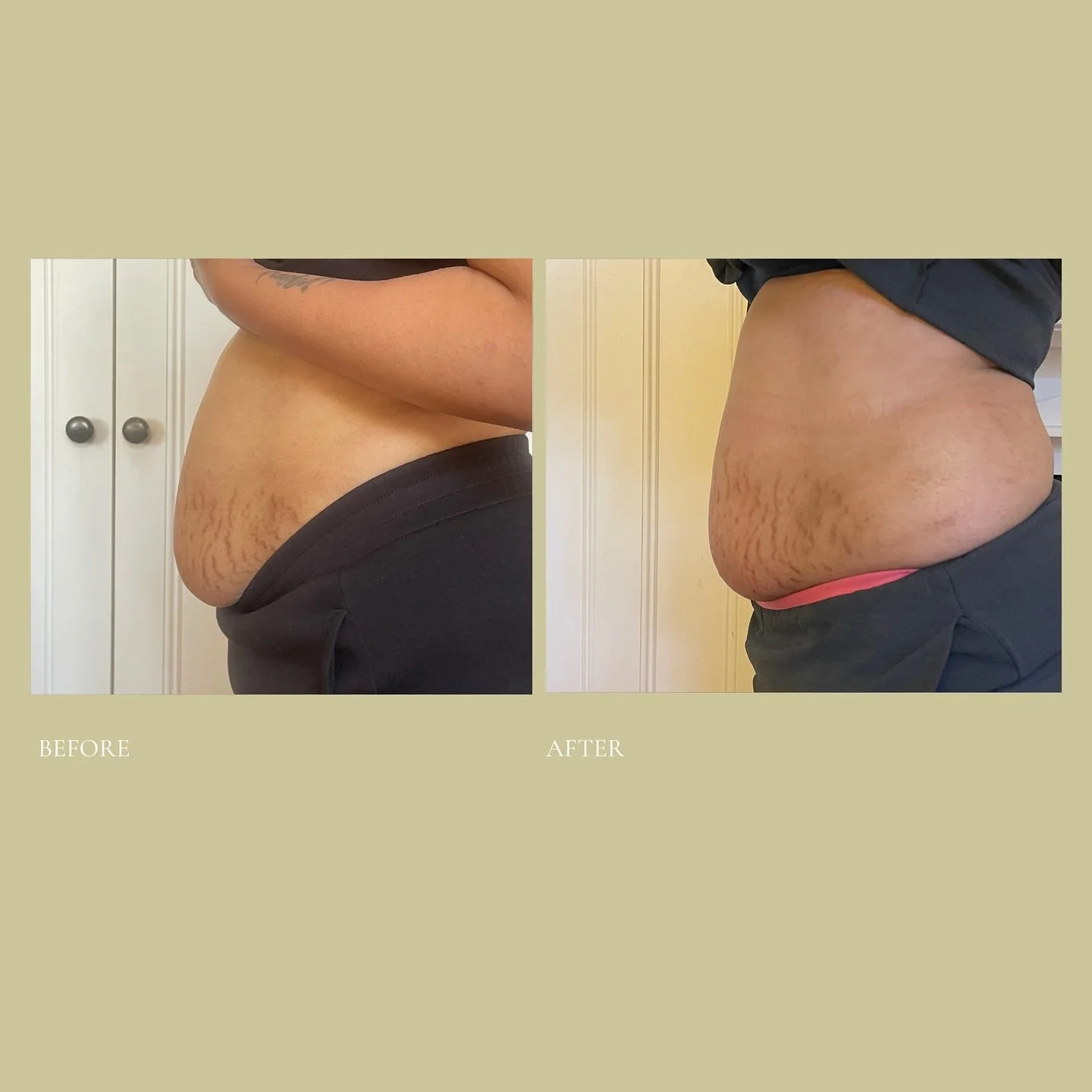 Our Signature Lift and Tuck Bundle 🤍

These results will keep developing in the months ahead as new muscle develops and further collagen is stimulated from our sessions. Our Lift and Tuck Bundle blends our signature non invasive tummy tuck with an u