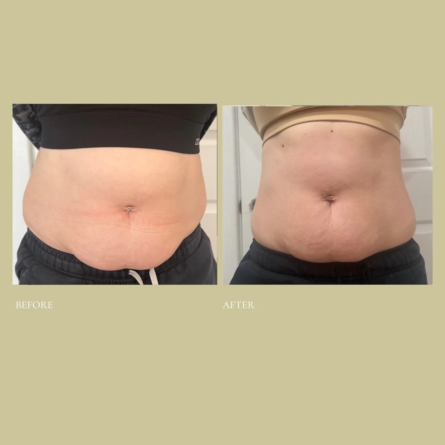 The Mumma Lift and Tuck Bundle 🤍

Two kids. Pilates. Eating well. Showing up consistently.
And still that lower belly. That soft ledge that just doesn&rsquo;t respond, no matter what you do.

Your body has done something incredible. It grew, nurture