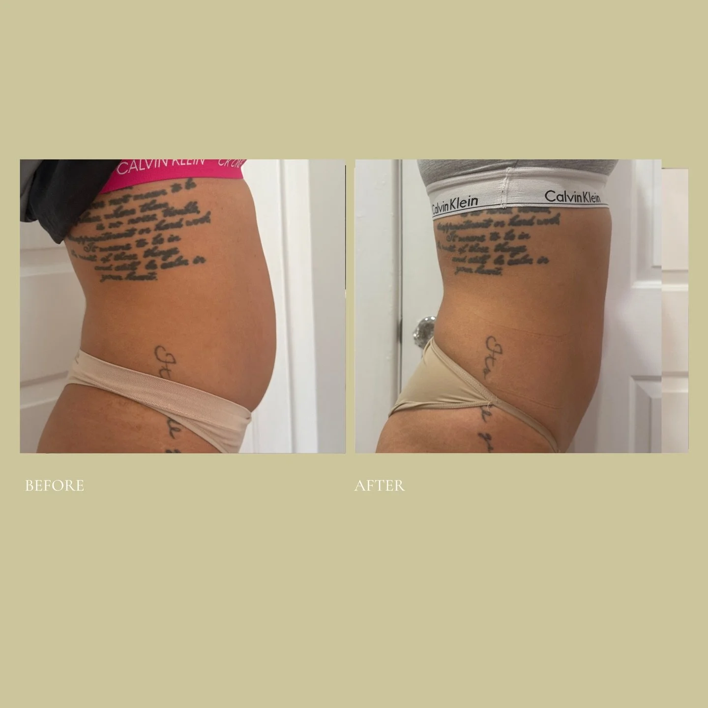 The non-invasive tummy tuck / ultimate core makeover, and yes, we have a version adapted for breastfeeding mums🤍

Notice the strength in her core. The way she&rsquo;s standing. Posture improved, bloating and retention reduced, and results will conti