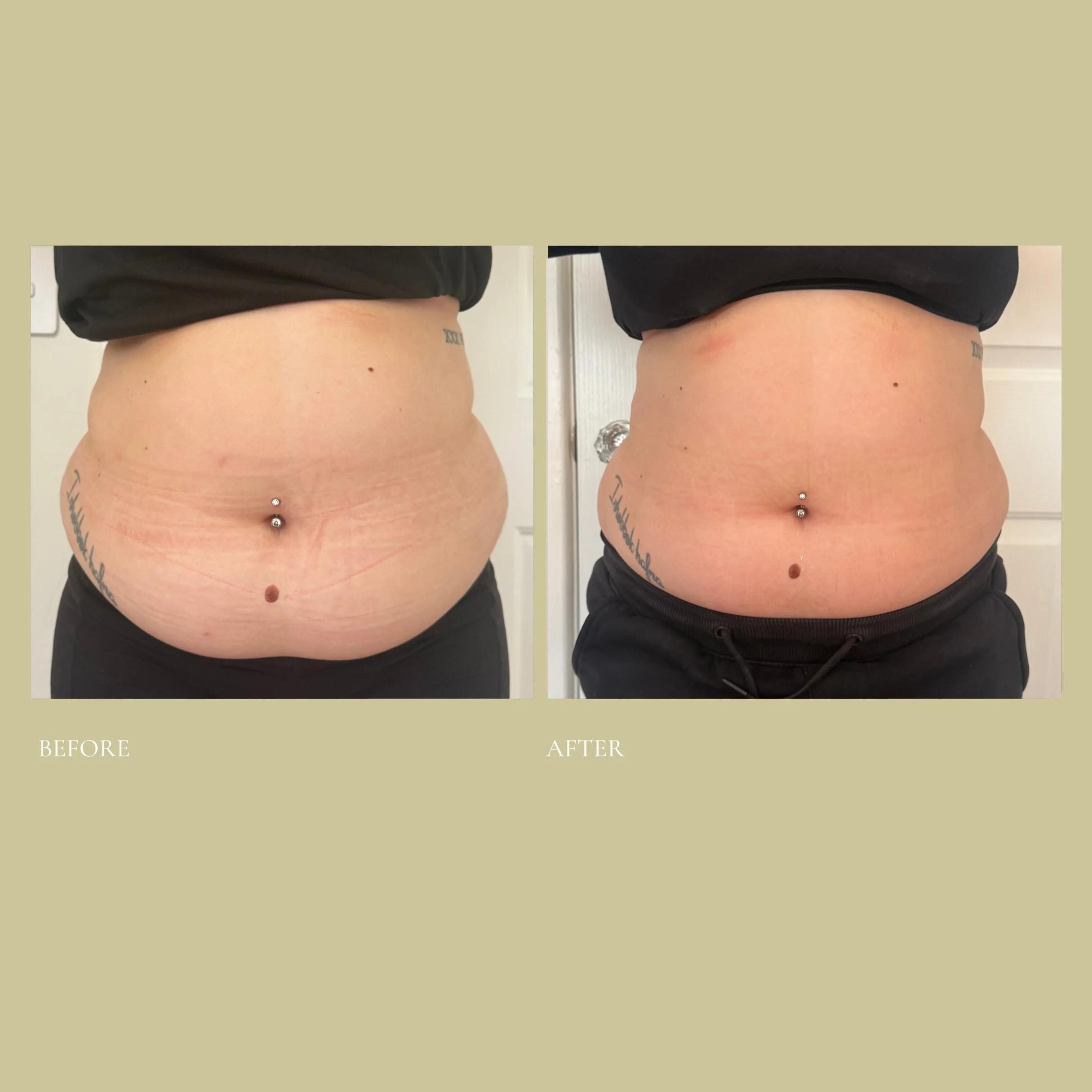 She came to us dealing with hormonal bloating, inflammation and stubborn volume around her midsection that just wouldn&rsquo;t shift no matter what she tried.​​​​​​​​​​​​​​​​

After a series of our Cleanse and Shape Method Stomach and Abdo sessions, 