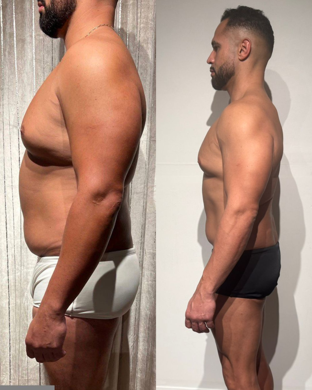 Side-by-side before-and-after image of Renato’s 17 kg body transformation with iG101CUT.