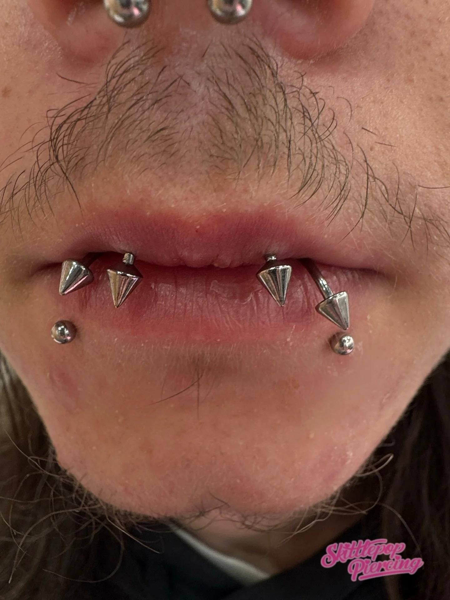 Kitty bites 🐈&zwj;⬛ 

(Inverse lip piercings) 

Before and after downsizing ! 
Over the moon with how these turned out. Definitely not something you see everyday. This was a real treat. Thankyou for the trust. 

#kittybites #inverselippiercing #lipp