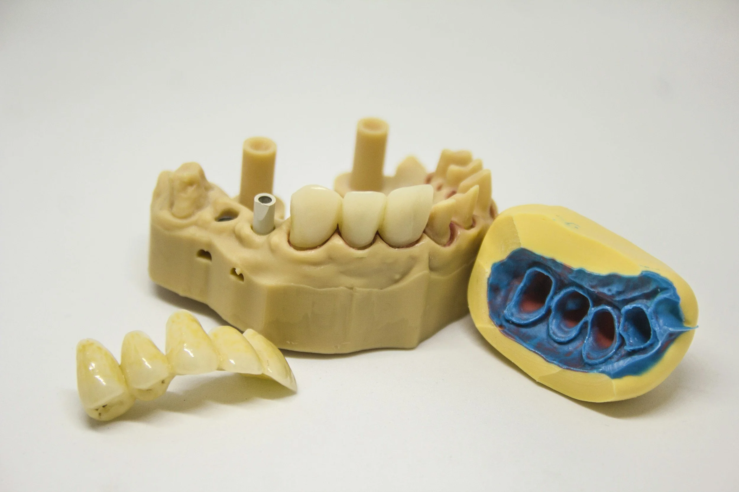 Dental mold with prosthetic teeth and impression.