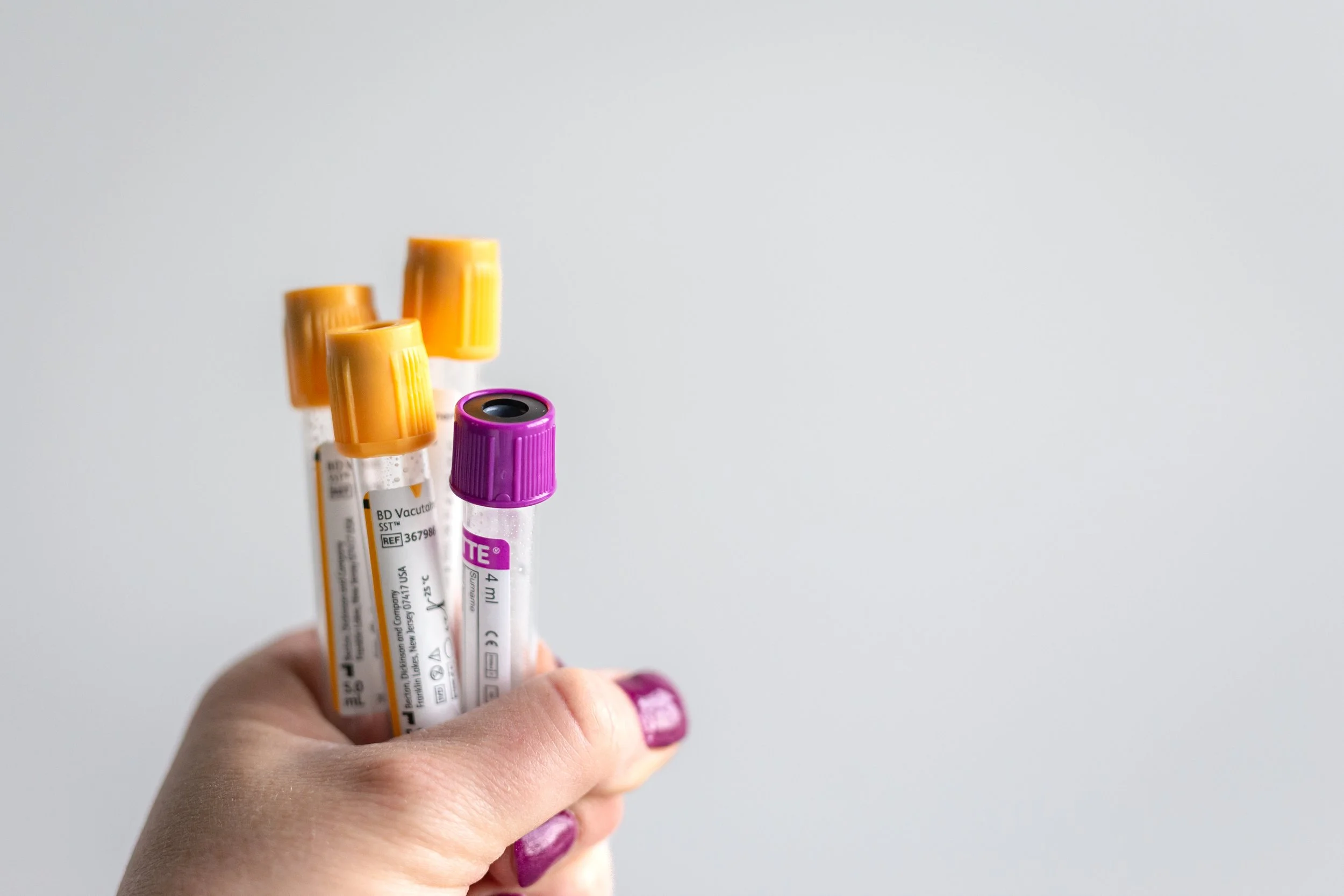 A hand holding three blood collection tubes with orange and purple caps, against a plain white background.
