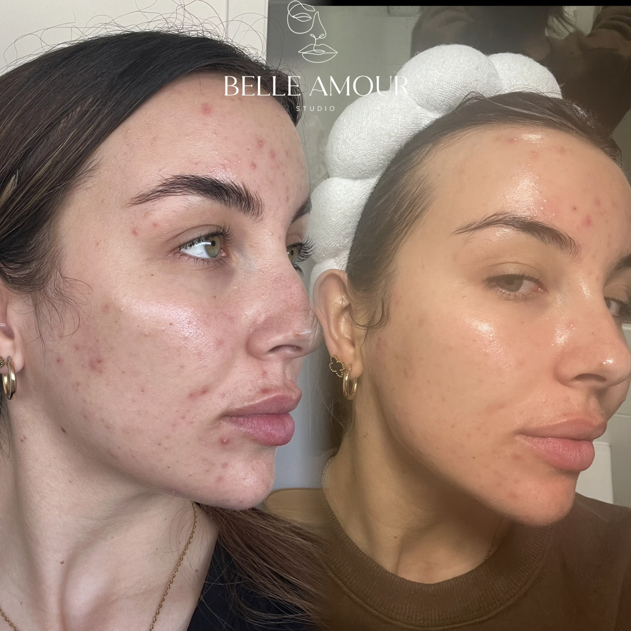 Before and after skincare treatment on a woman's face with acne improvement, showcasing clearer skin. Belle Amour Studio logo included.