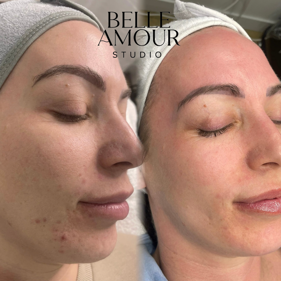 Side-by-side comparison of a woman's face before and after a skincare treatment at Belle Amour Studio, showing improved skin texture and reduced redness.
