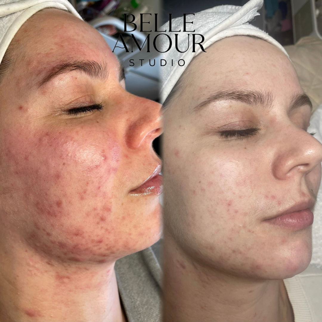 Side-by-side images of a woman's face showing acne treatment results, with noticeable improvement on the right side, from Belle Amour Studio.