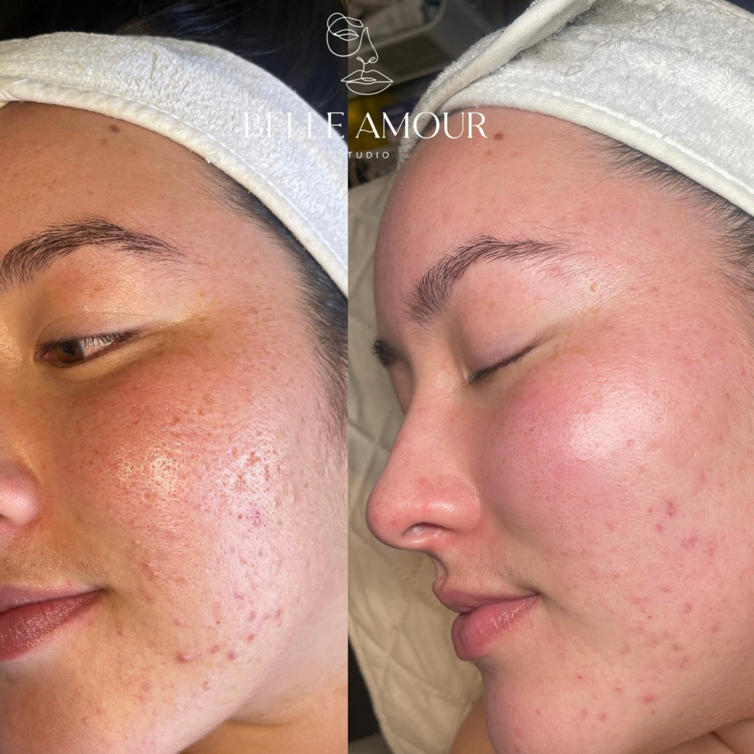 Before and after facial treatment showing skin improvement.