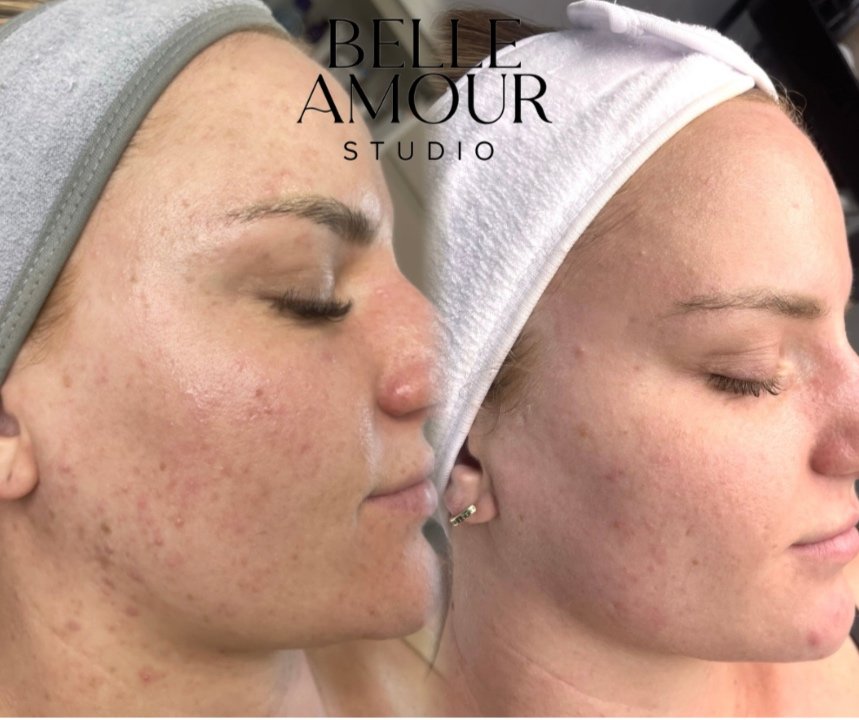 Close-up of a woman's face with different skincare treatments, showing before and after effects on skin texture and clarity. The woman has closed eyes and wears a headband in both images. Text "BELLE AMOUR STUDIO" is present at the top.