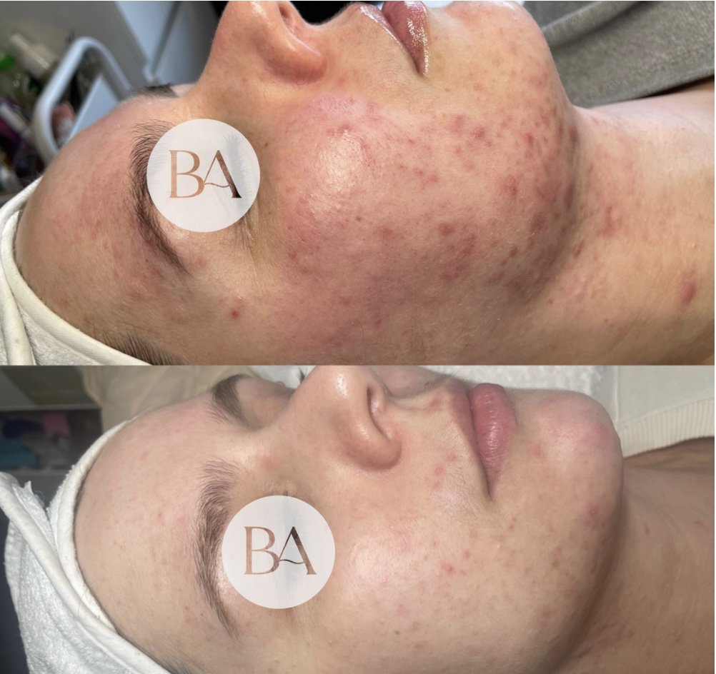 Before and after skincare treatment with reduced acne and smoother skin.