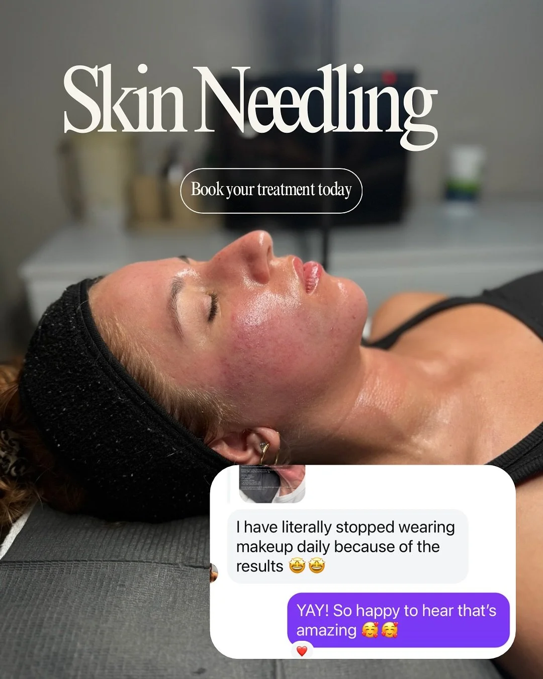 💉 The Phases of Skin Needling 🪄 

When we perform skin needling, we&rsquo;re creating controlled micro-injuries in the skin &mdash; triggering your skin&rsquo;s natural wound-healing response. This process happens in 3 main phases:
⸻
1. Inflammator