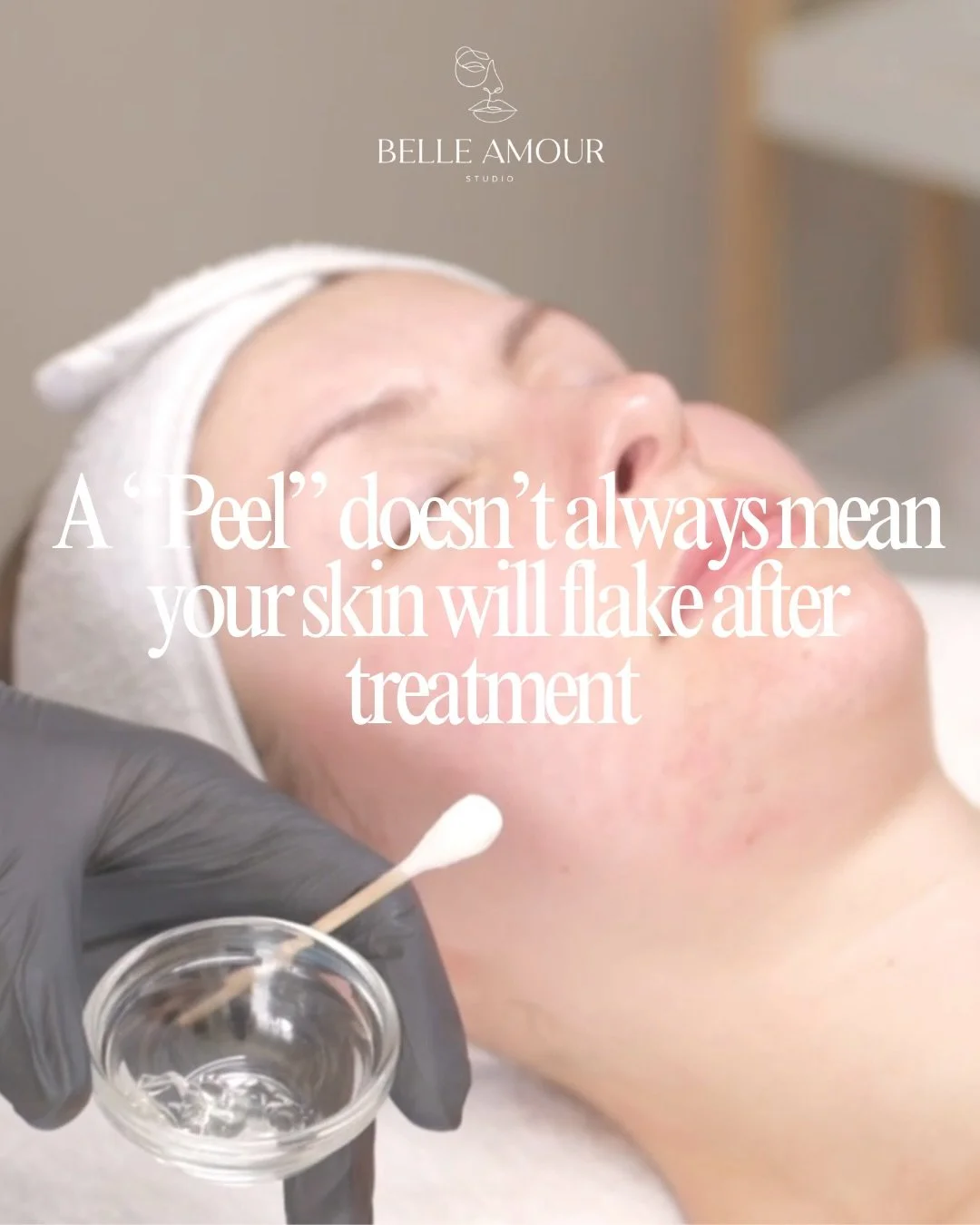 A common misconception we hear 
&ldquo;If my skin didn&rsquo;t peel, did the treatment even work?&rdquo; 🪄 

The truth? Not all peels are designed to cause visible shedding. Actually many don&rsquo;t have shedding at all. 

At Belle Amour Studio, we
