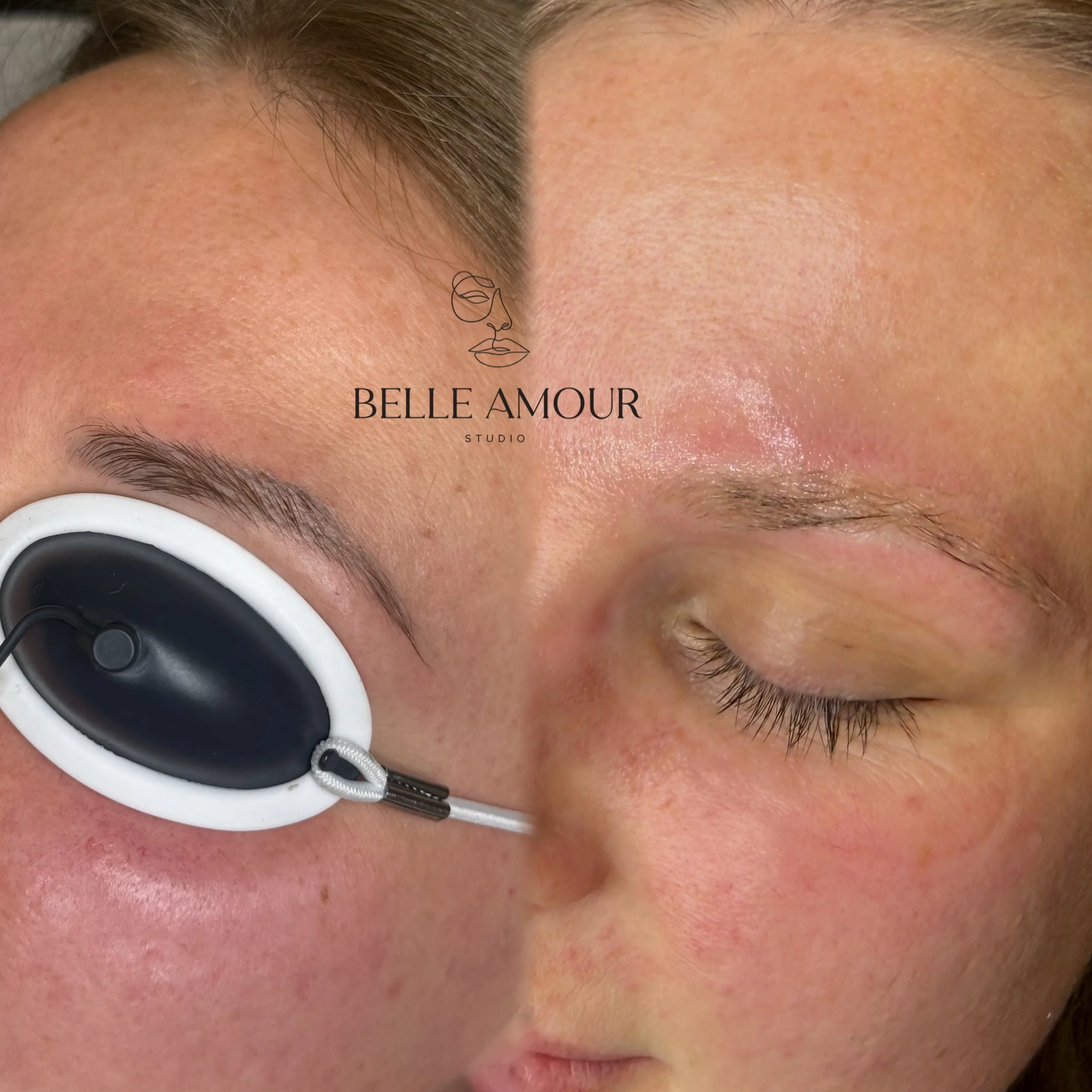 Brow tattoo Laser Removal ⚡️ 

Removal is so much easier than people think, these brows will be ready for retattoo after just 1 laser session. 🪄 

It&rsquo;s time to say goodbye to those ashy, over-saturated eyebrows 👋🏼✨

Laser removal helps break