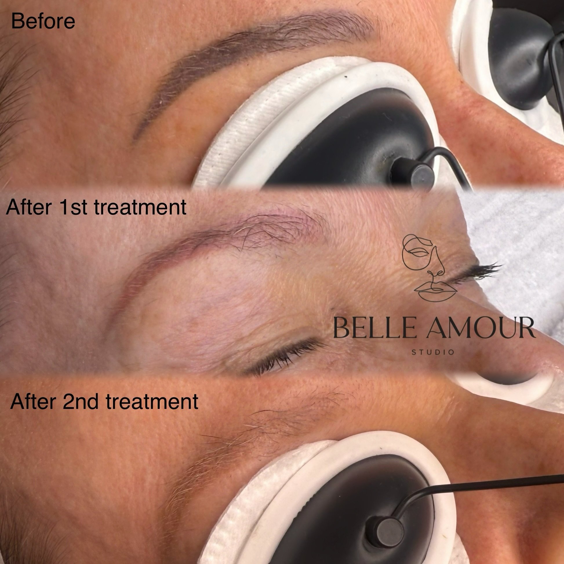 Laser Brow Tattoo removal results ⚡️ 

After just 2 sessions this client will be ready for retattoo 🪄  IF you DON&rsquo;T love your existing brow tattoo, this is your SIGN TO REMOVE THEM 👏 

Treatment 1: target the over saturated, grey tones 
Treat
