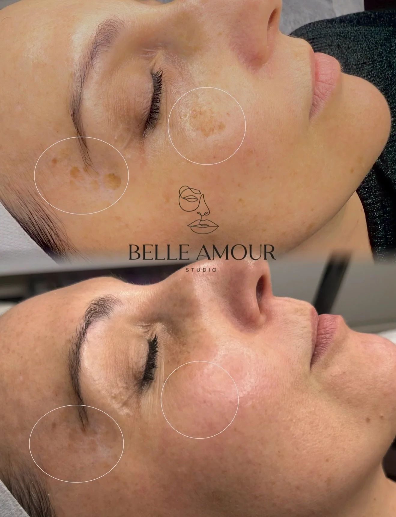 Results from just ONE PicoLaser Pigmentation removal &amp; rejuvenation treatment 🪄 

Why do we get pigment? Sun exposure stimulates your melanocytes to produce more melanin, which can leave you with sun spots, pigmentation, freckles and uneven skin