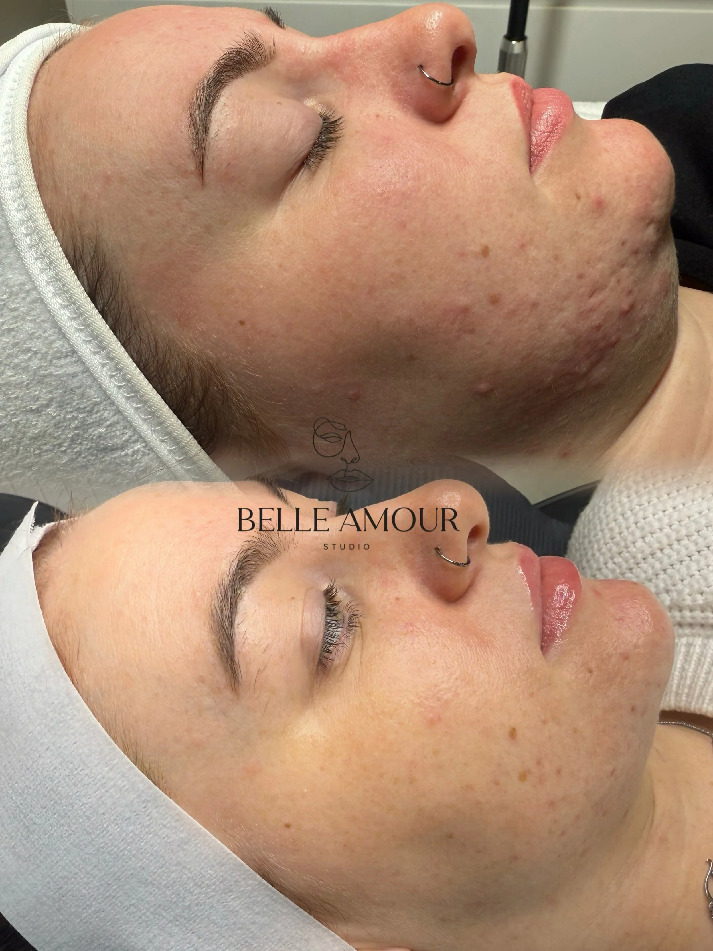 Skin transformation 🪄 

Look at how much clearer, less inflamed, brighter and more glowy the skin is 😍 

Guess what? 👀 
I&rsquo;m going to tell you EXACTLY how we got these results: 
▫️ We started with peels to decongest the skin, a mixture of @as