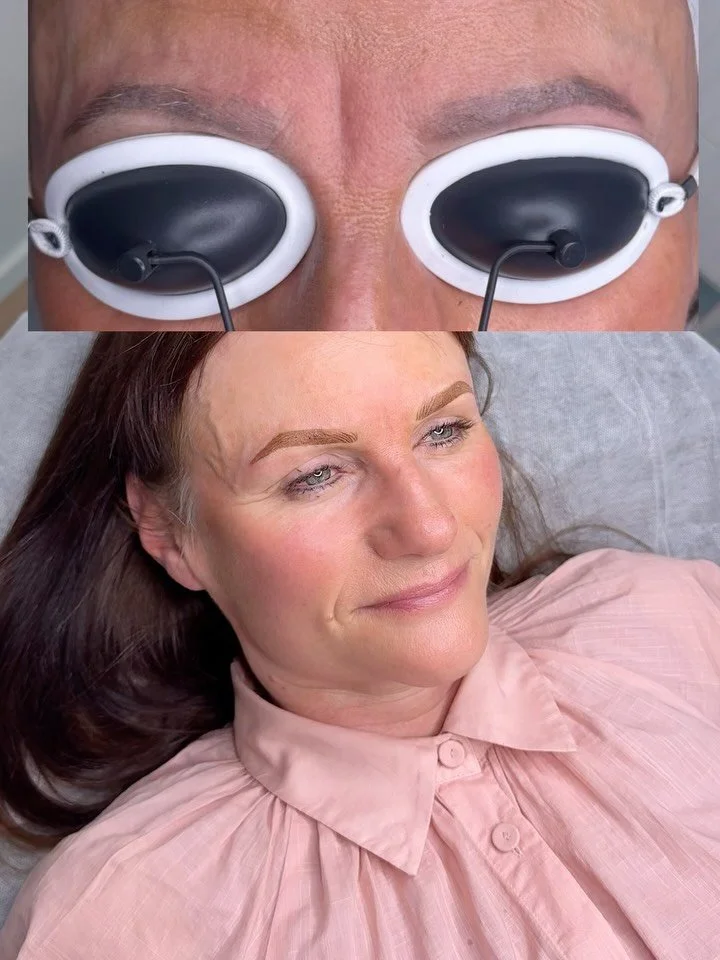Let&rsquo;s see this process of Laser Brow Tattoo removal ⚡️ 

What did we start with? 👀 
1. Tattoo work (not done by me), deep Microblading through the fronts that caused a lot of scarring and scar tissue.

2. A second artist tried to cover which c