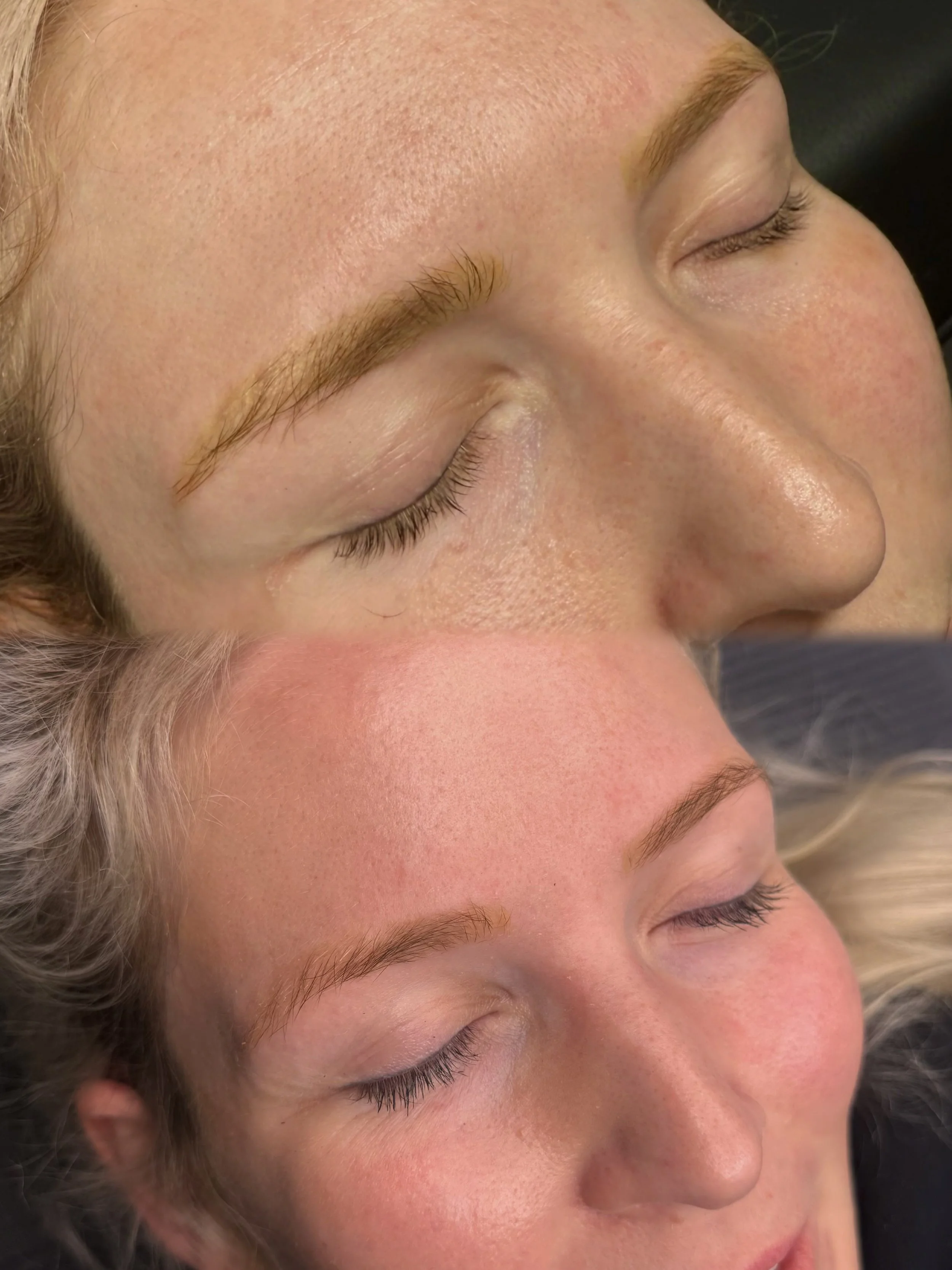 Professional laser brow tattoo removal in Christchurch for fading unwanted, dark or discoloured cosmetic eyebrow tattoo pigment.