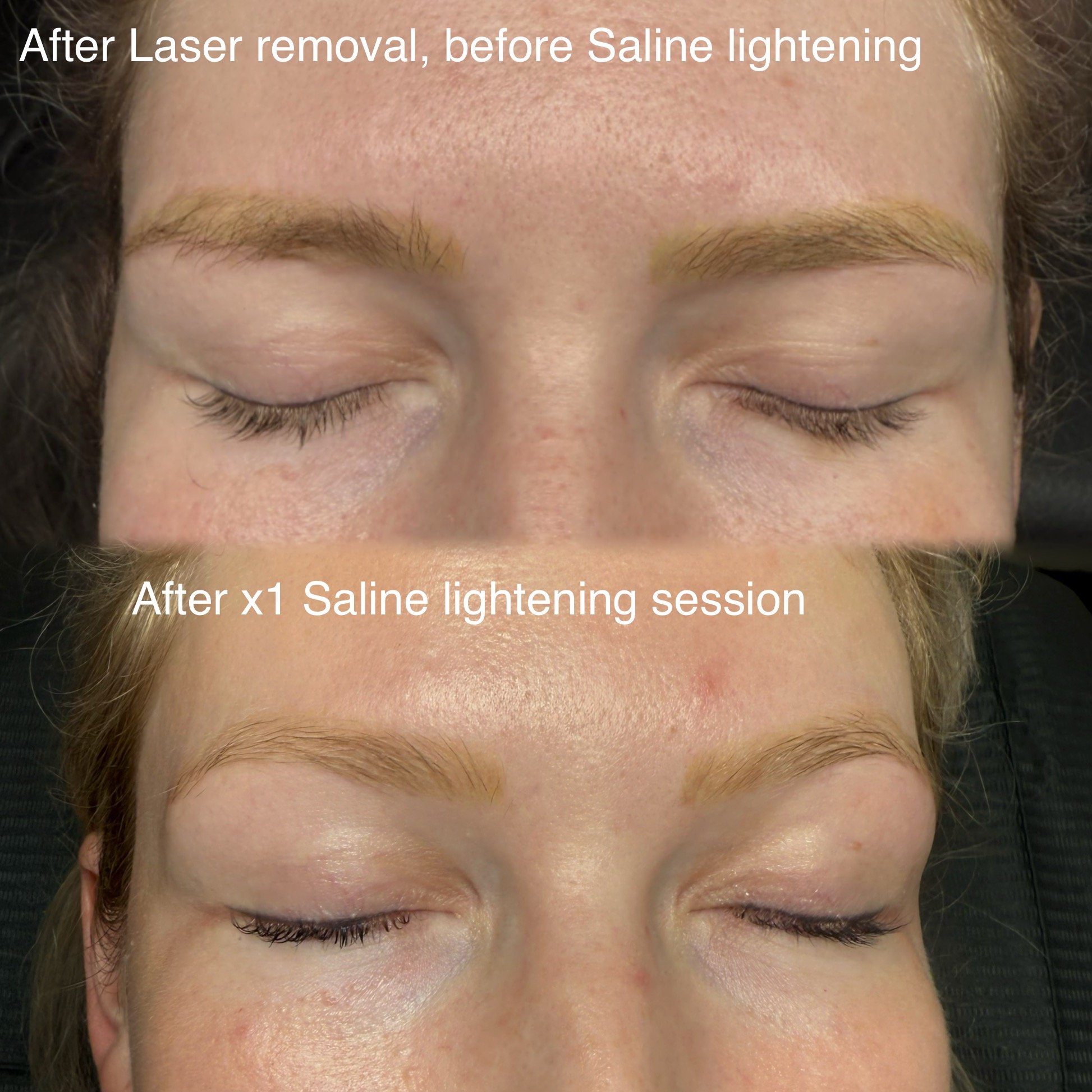 Before and after saline eyebrow tattoo removal in Christchurch showing lightened cosmetic tattoo and corrected brow shape.