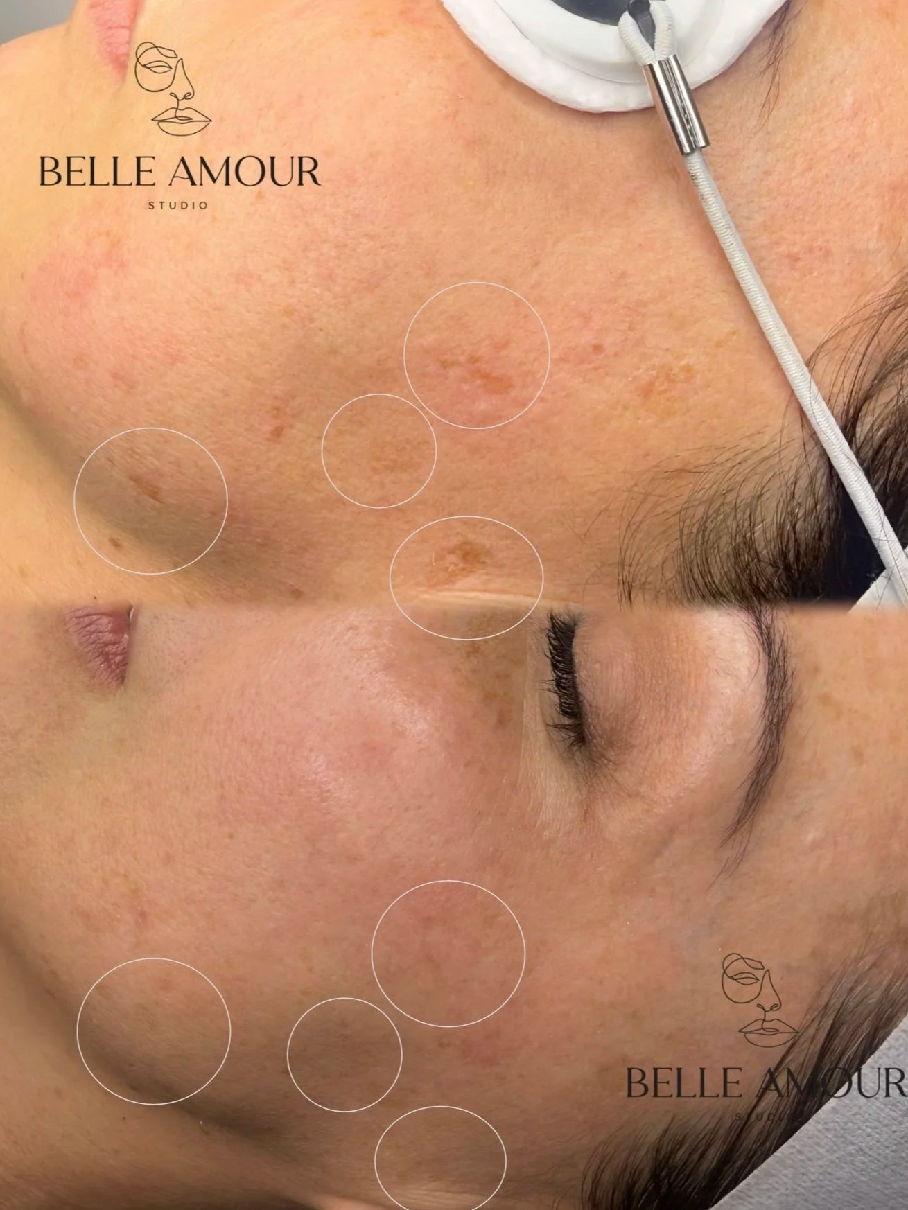 Laser pigmentation removal in Christchurch to target sun damage, dark spots, and pigmentation for a brighter, more even skin tone.