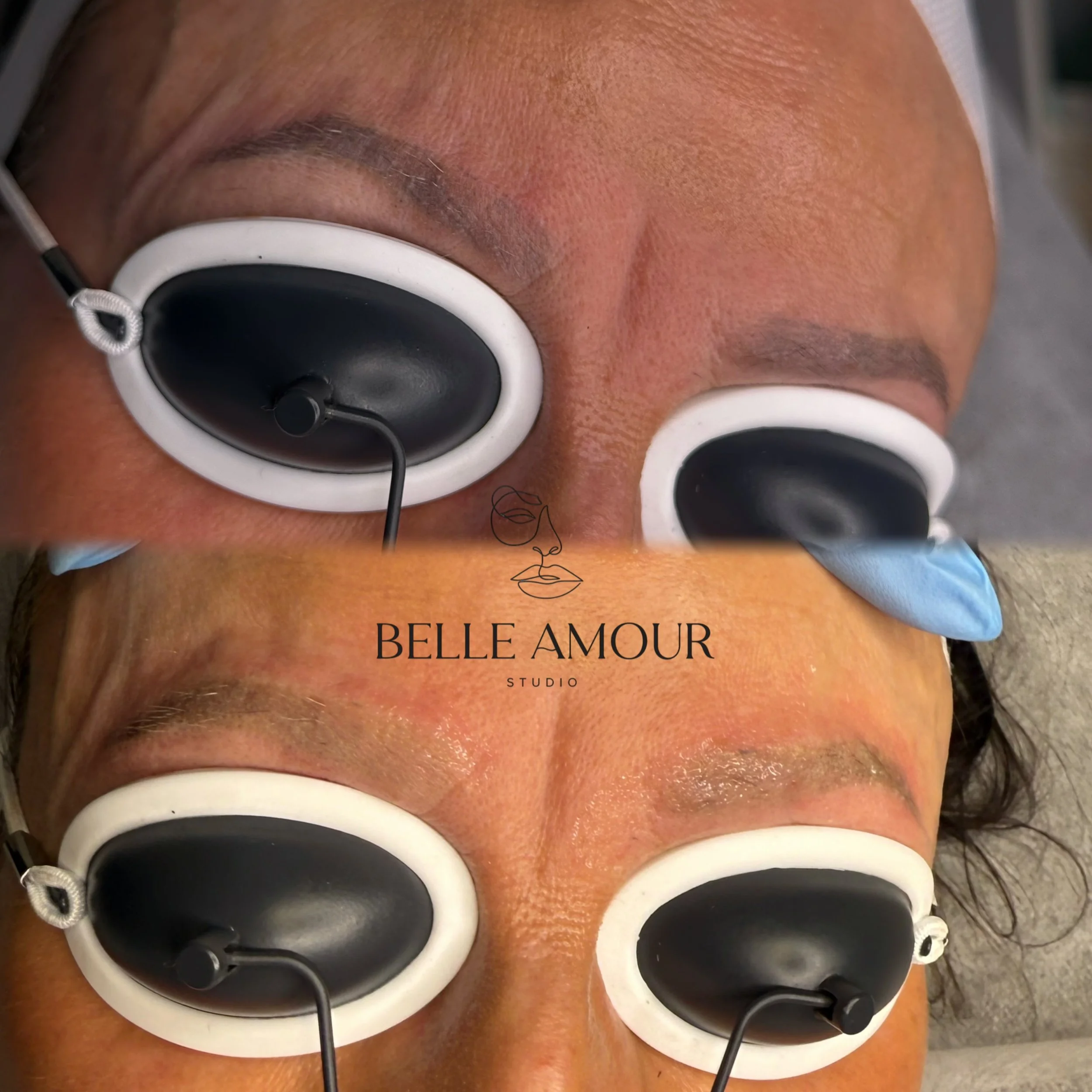 Before and after laser eyebrow tattoo removal in Christchurch using Pico laser technology for targeted cosmetic tattoo fading.