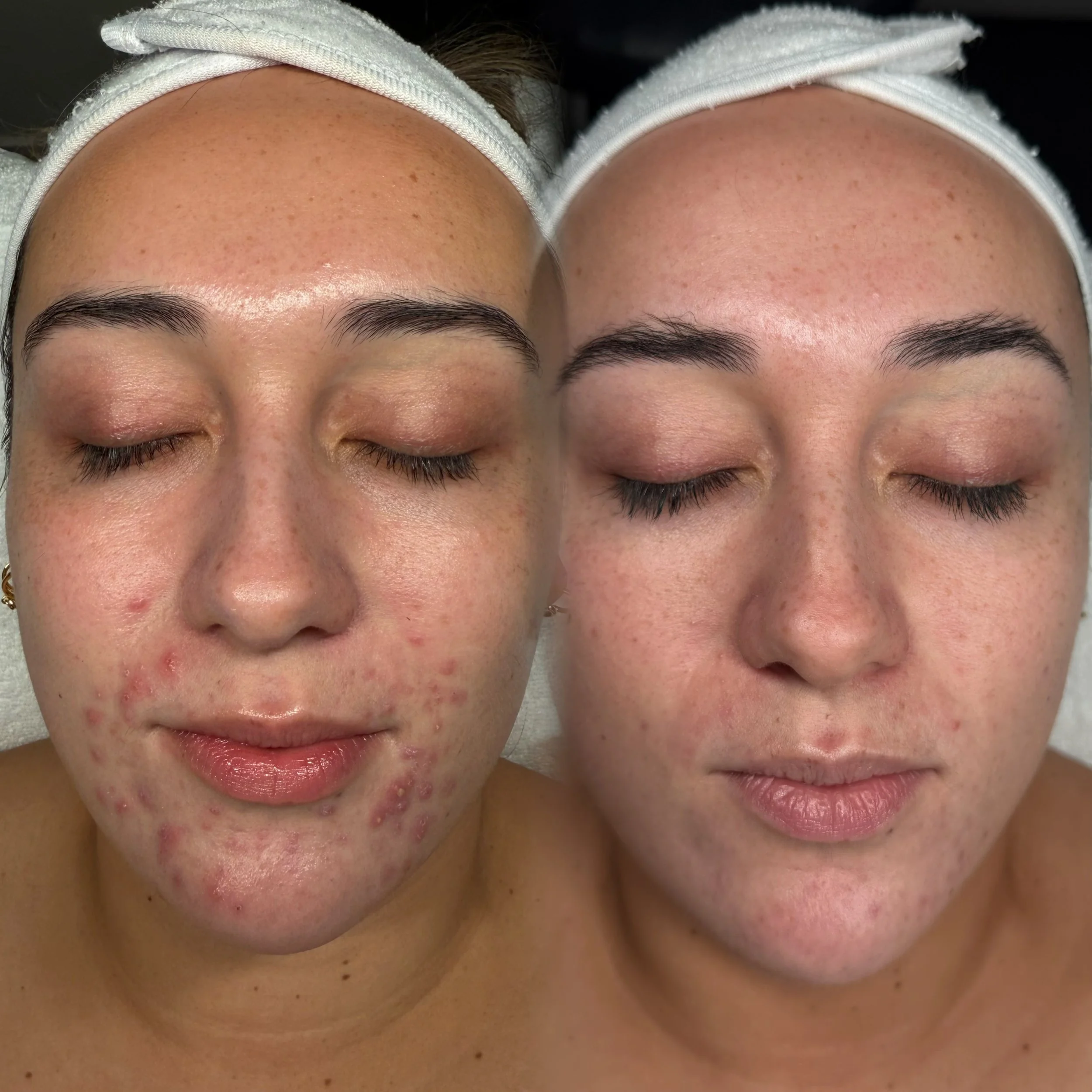 Skin needling treatment designed to reduce enlarged pores, pigmentation and fine lines in Christchurch.