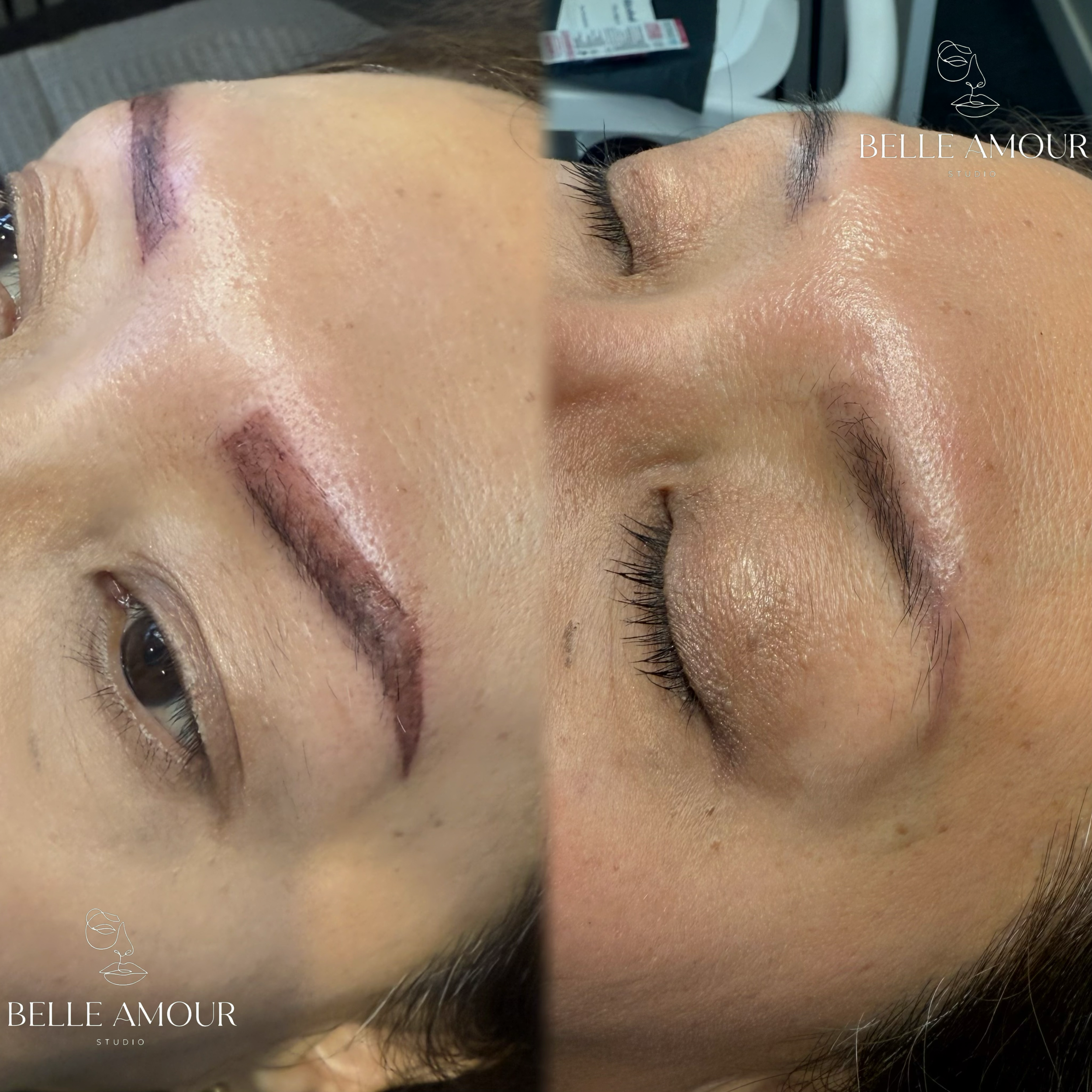 Christchurch specialist offering saline removal of unwanted eyebrow tattoos with minimal scarring.
