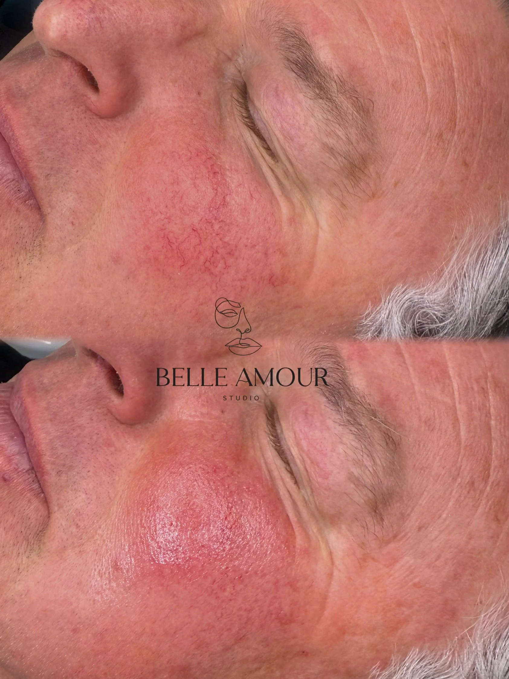 Red vein removal Christchurch using electrolysis at Belle Amour Studio to target visible facial capillaries and small red veins.
