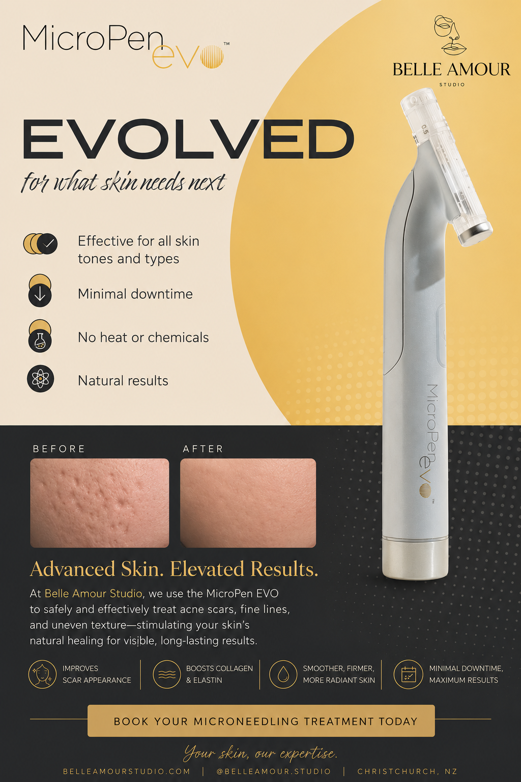 Microneedling Christchurch skin treatment designed to improve the appearance of acne scarring, uneven texture and overall skin quality.