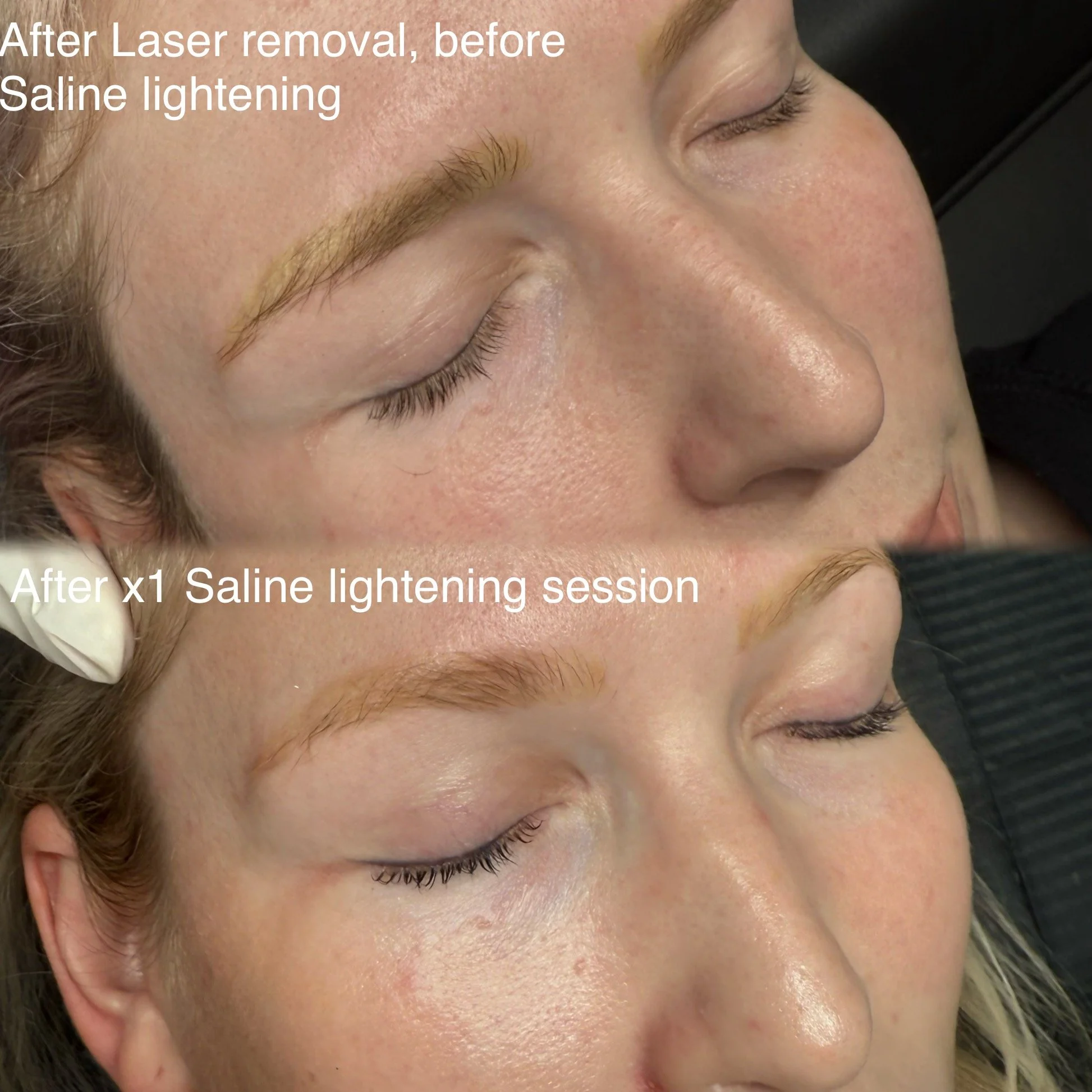 Professional saline eyebrow tattoo removal in Christchurch with visible before and after results of cosmetic brow tattoo fading.