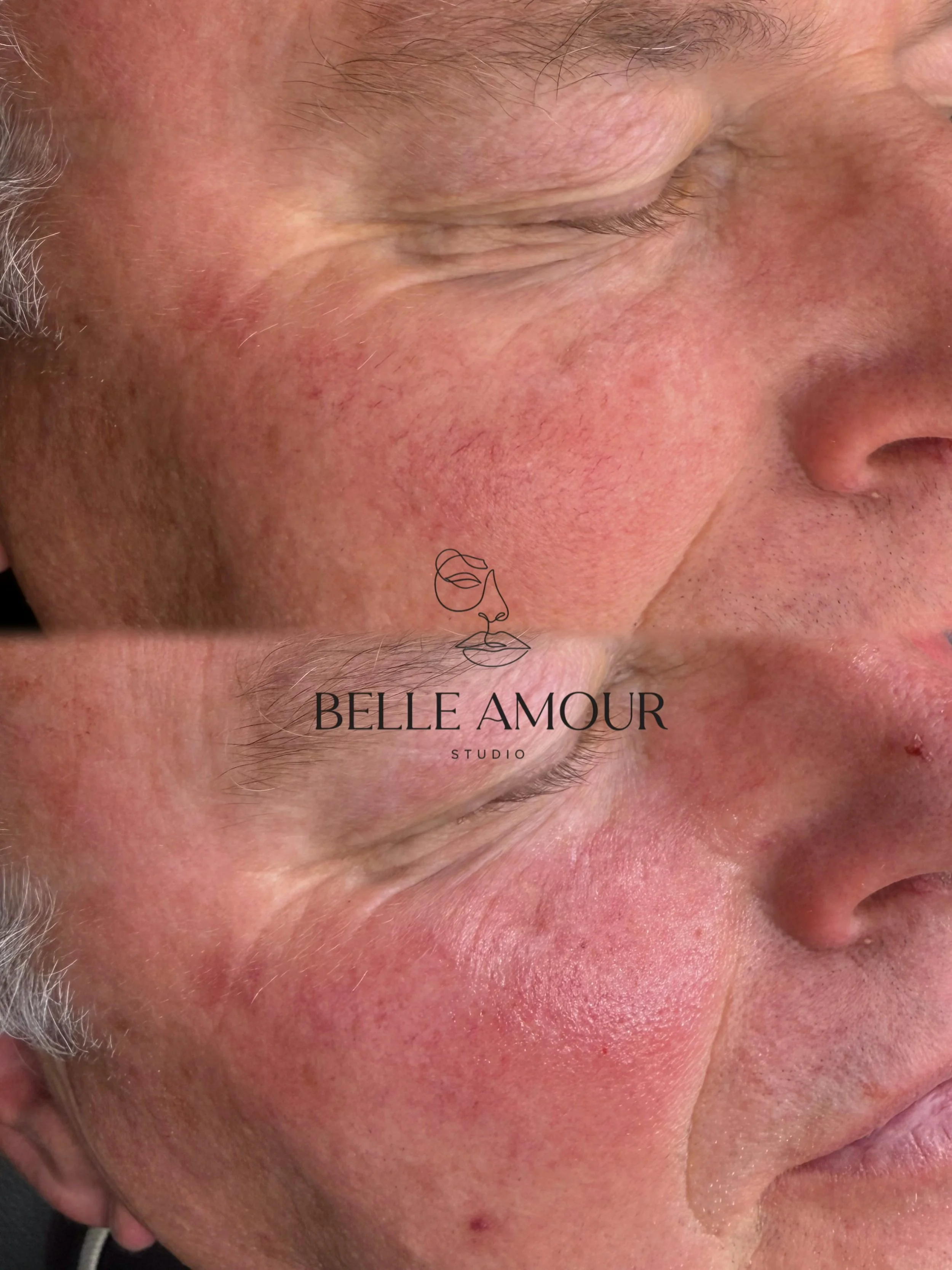 Electrolysis red vein treatment in Christchurch at Belle Amour Studio for the appearance of broken capillaries around the nose, cheeks and chin.