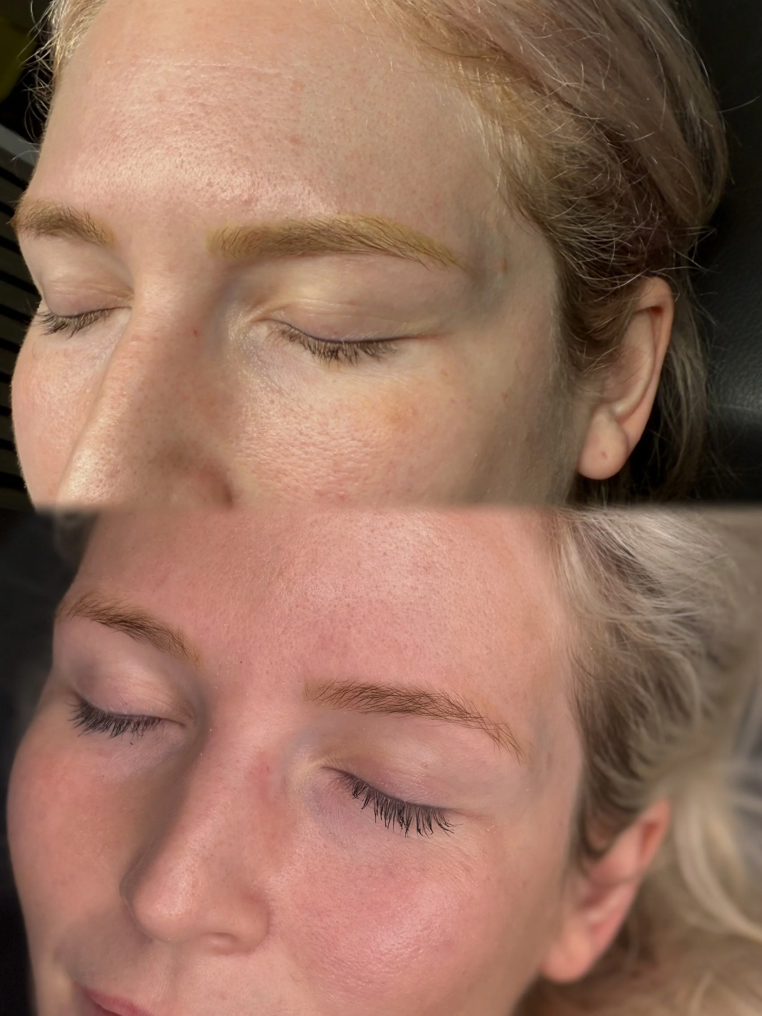 Professional saline brow tattoo removal treatment in Christchurch, safely lifting unwanted cosmetic eyebrow tattoo pigment.