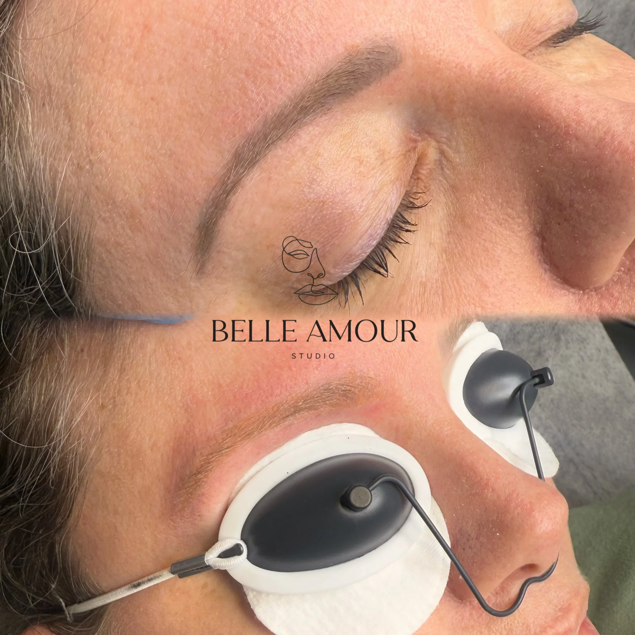 Professional laser brow tattoo removal in Christchurch at Belle Amour Studio, helping fade unwanted cosmetic eyebrow tattoo pigment