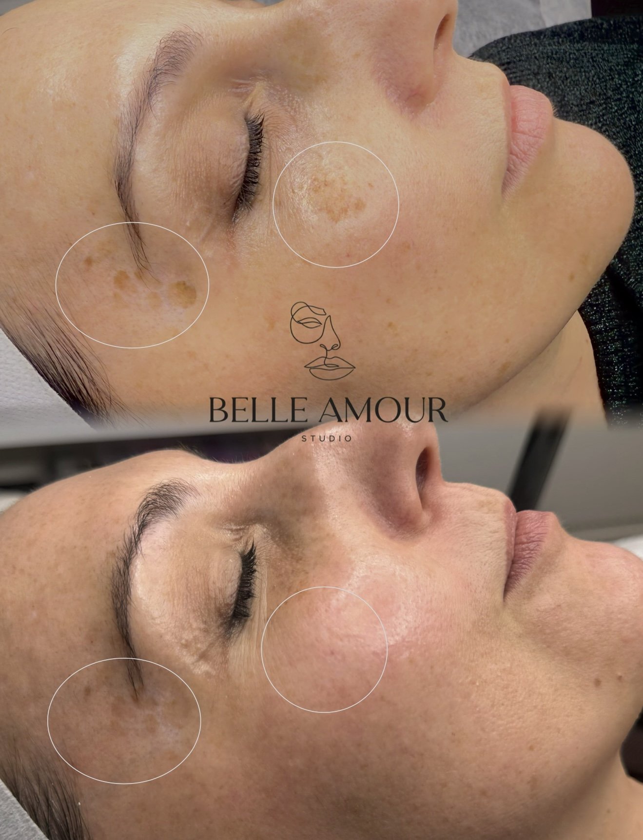 Laser pigmentation removal treatment in Christchurch, helping reduce sun spots, age spots, and uneven skin tone for clearer, more radiant skin.