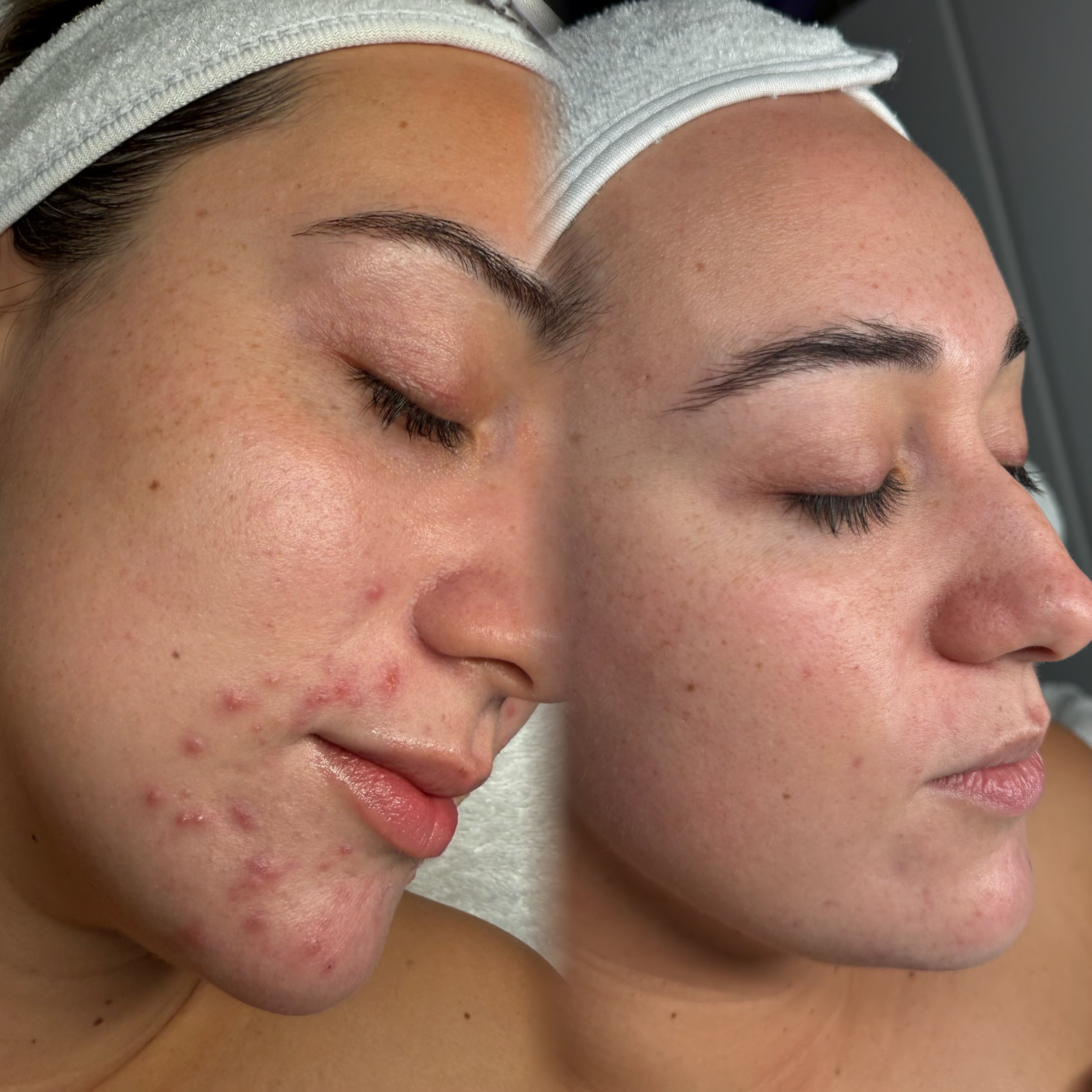 Advanced microneedling treatment for brighter, healthier-looking skin at Belle Amour Studio Christchurch.
