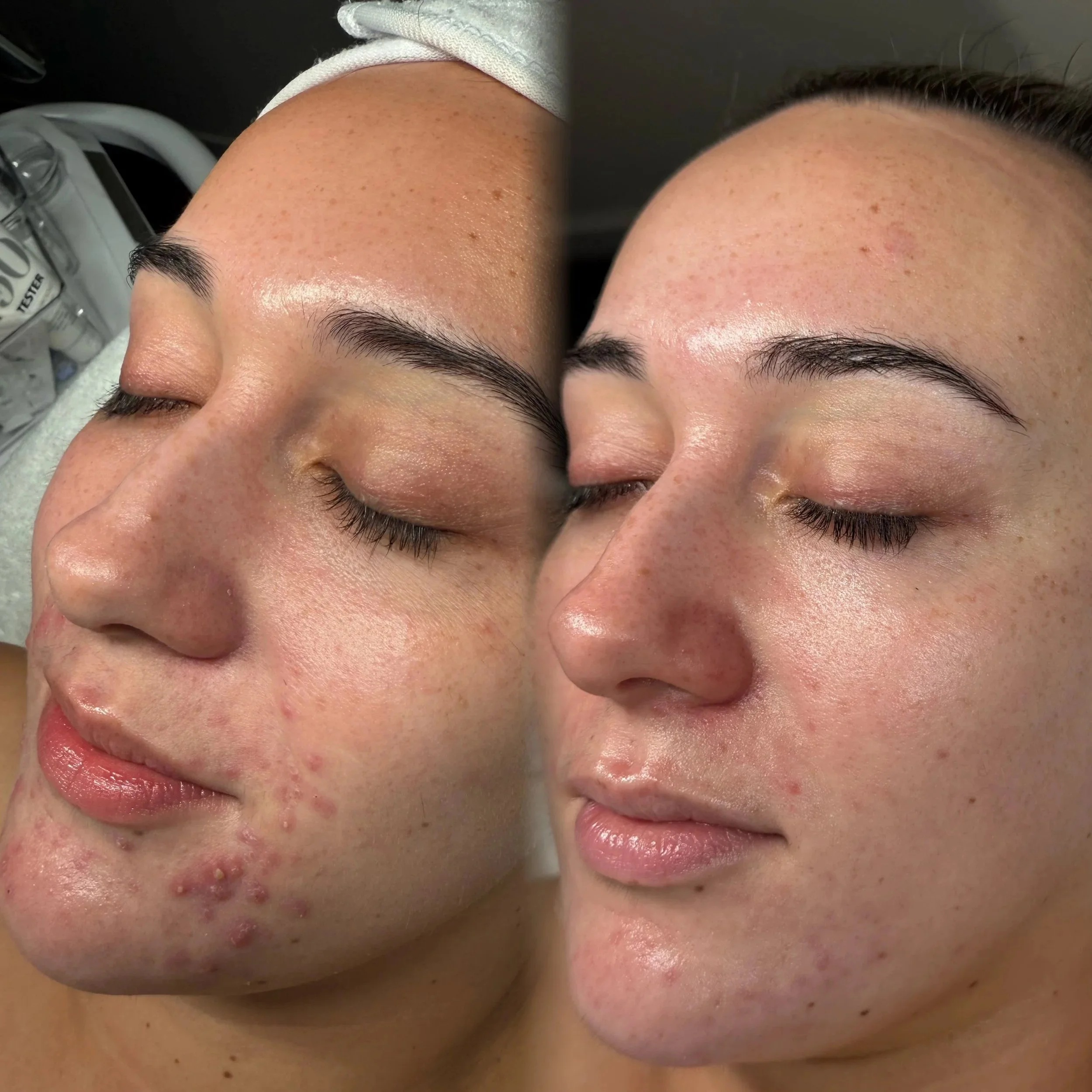 Microneedling treatment in Christchurch targeting fine lines, acne scars and overall skin rejuvenation.