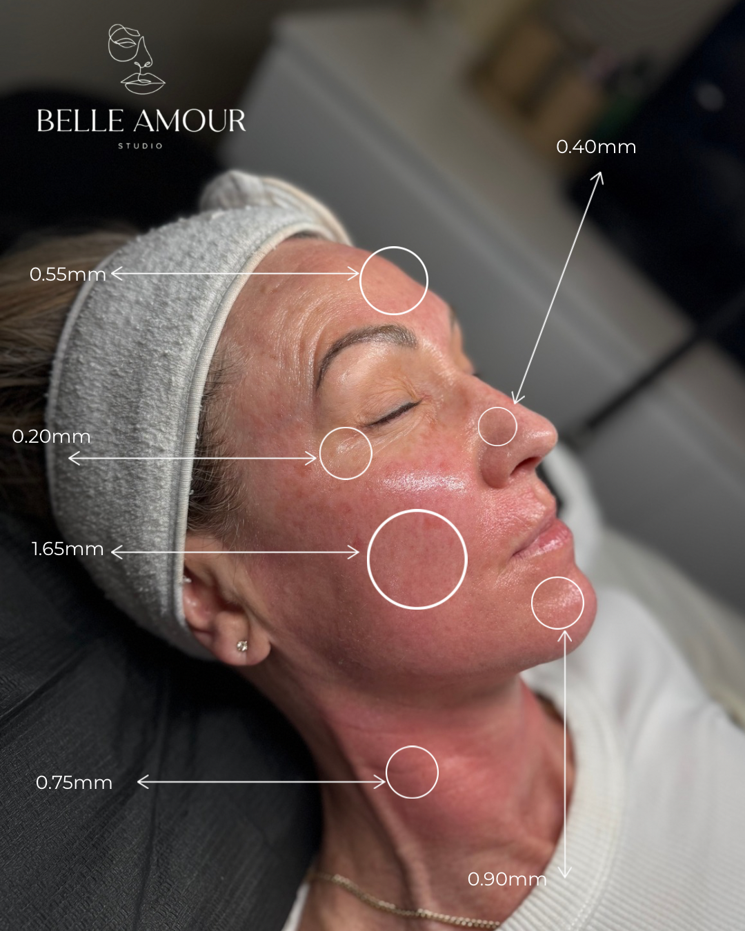 Before and after results of microneedling in Christchurch showing improved skin texture and reduced fine lines.