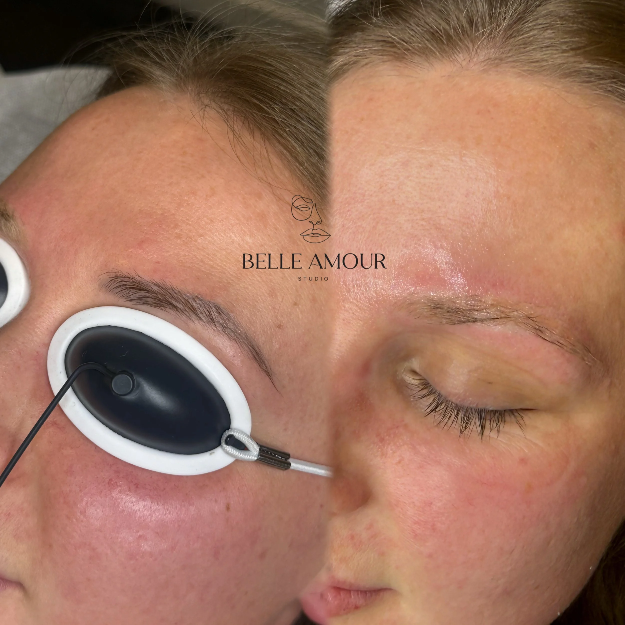 Professional picosecond laser brow tattoo removal treatment in Christchurch, safely fading unwanted cosmetic eyebrow tattoo pigment while protecting the natural brow hairs.