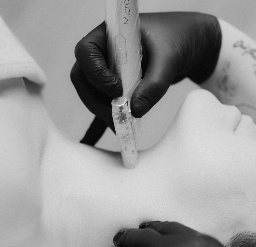 Microneedling for acne scars and smoother skin at Belle Amour Studio in Christchurch.