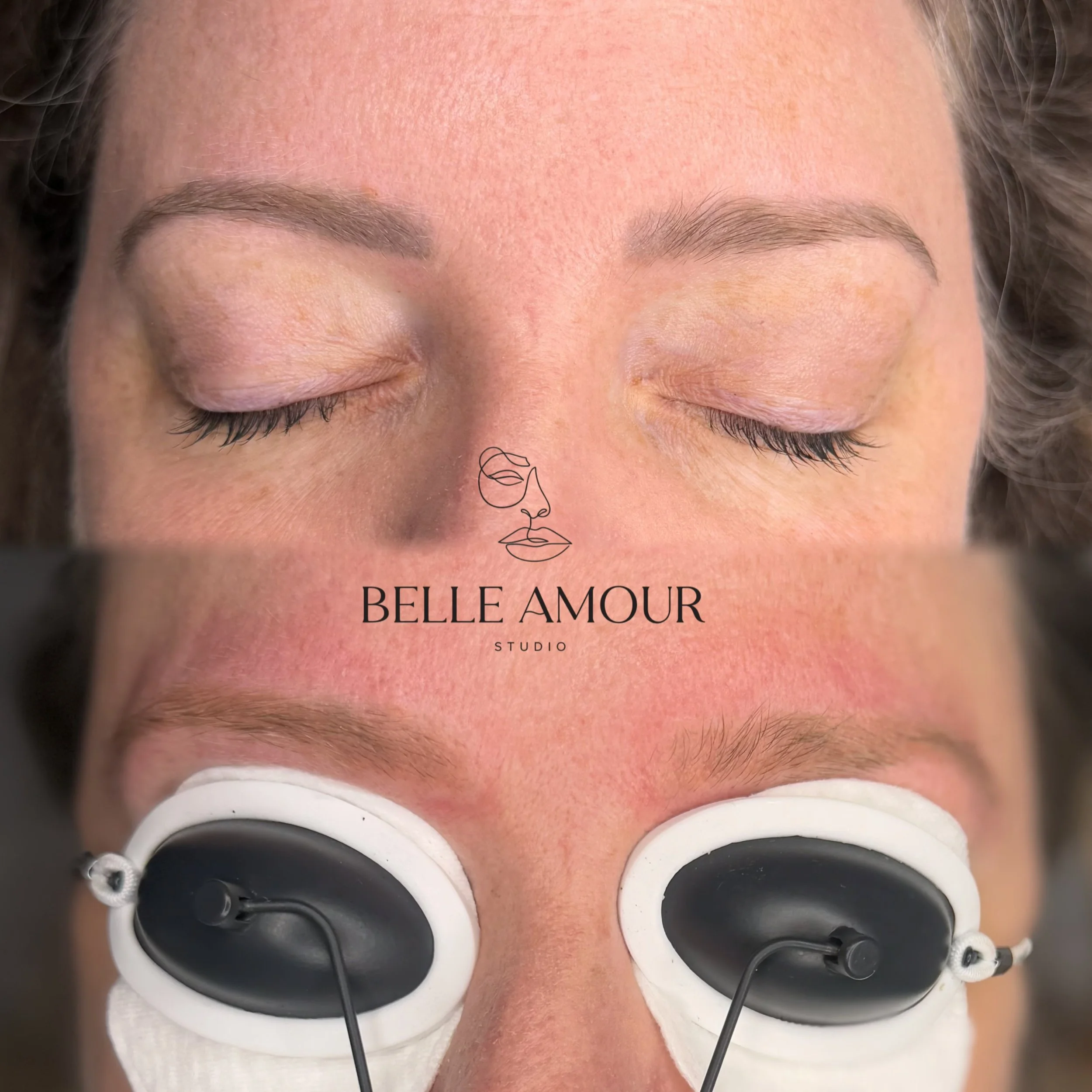 Pico laser brow tattoo removal Christchurch treatment at Belle Amour Studio for unwanted, faded or discoloured eyebrow tattoo pigment.