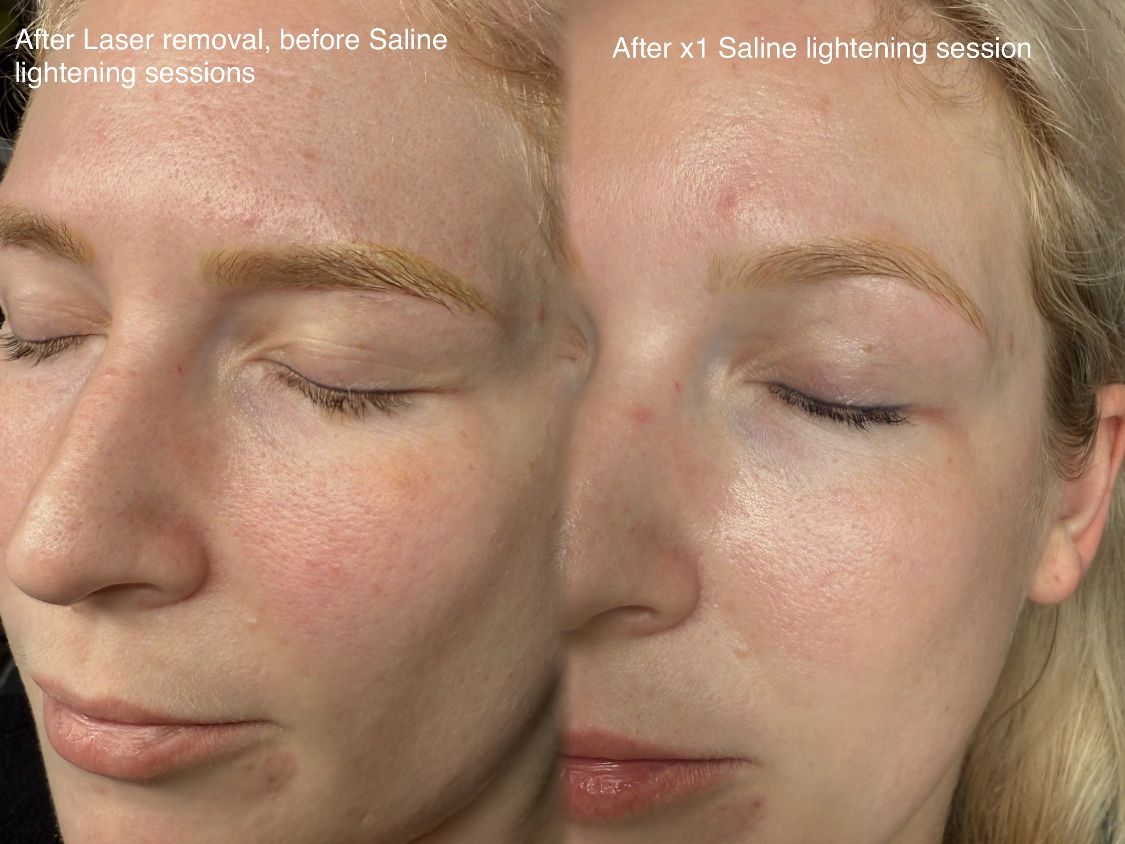 Saline brow tattoo removal results in Christchurch, New Zealand – before and after faded eyebrow tattoo treatment