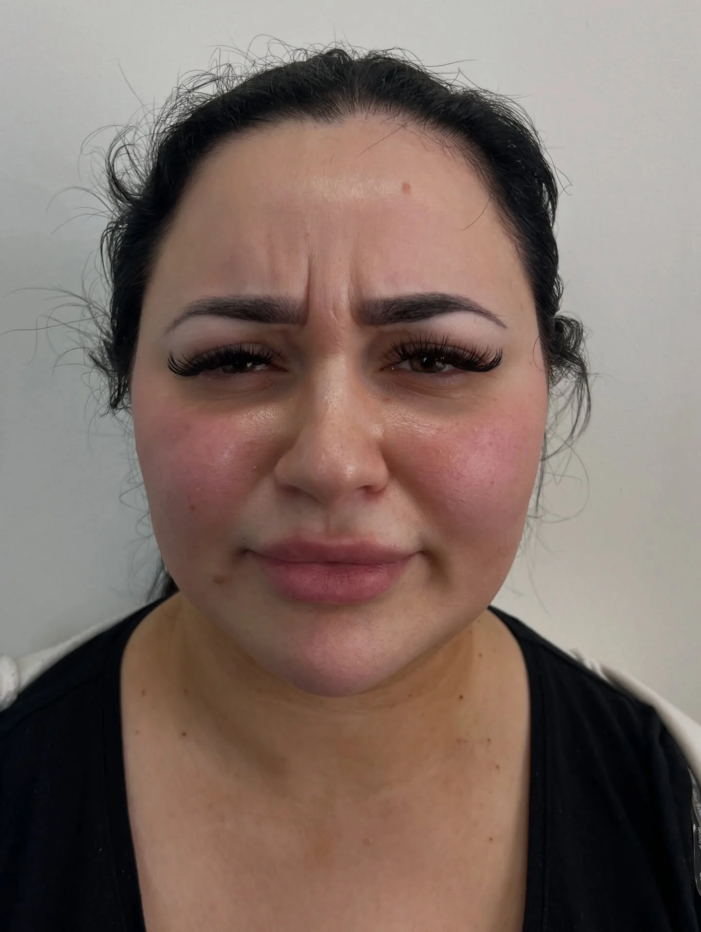 Those lines between the brows? They&rsquo;re caused by years of natural expression, a normal part of how our faces move and age.

We use this muscle when we&rsquo;re frowning, concerned, concentrating, squinting, or even adjusting our glasses. Over t