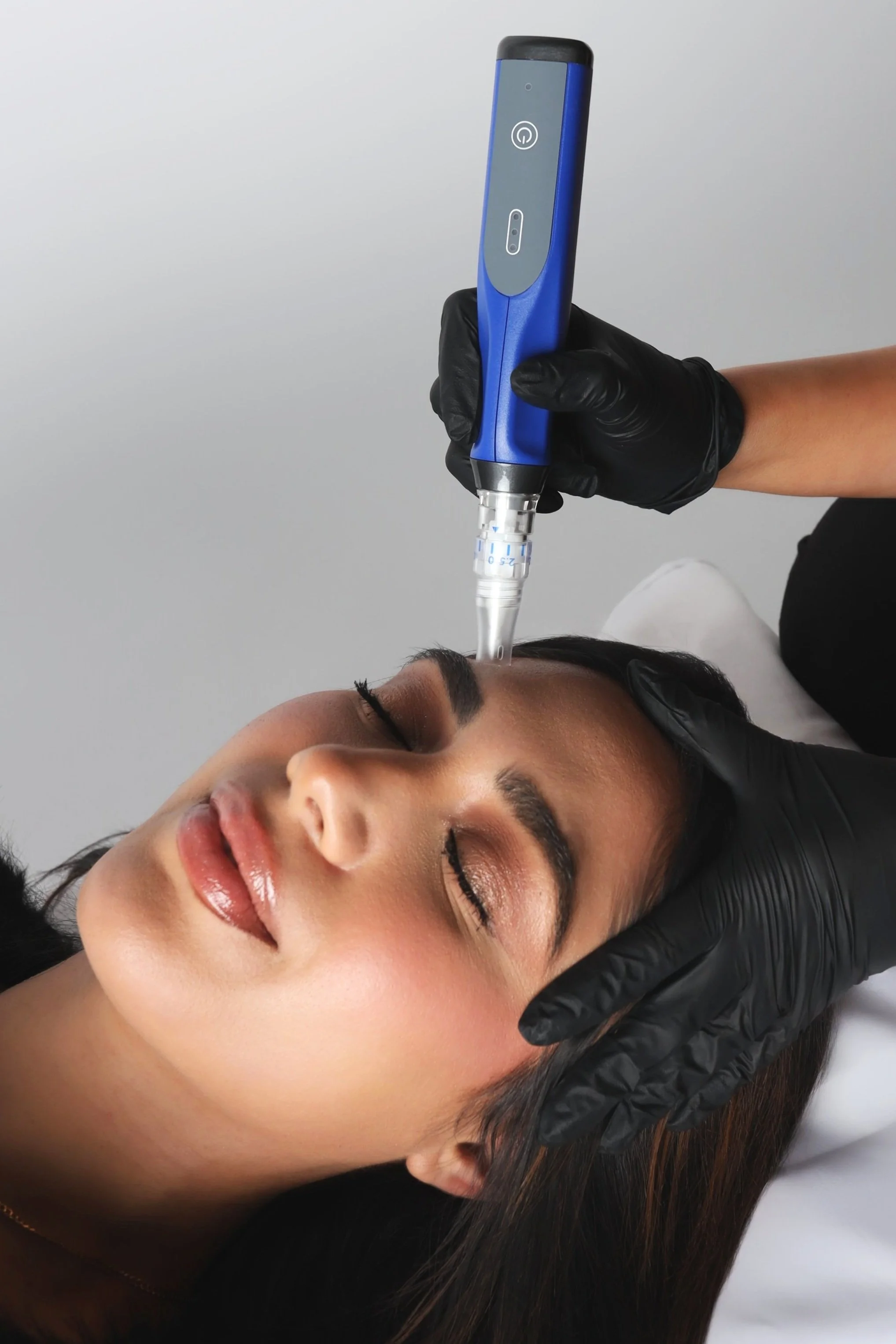 A person receiving a microneedling procedure on their forehead, administered by another individual wearing black gloves and holding a blue microneedling pen.