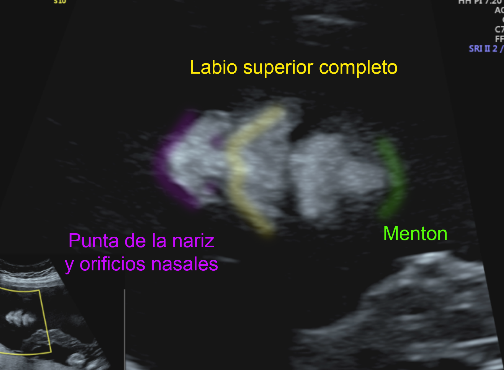 labio superior fetal.png