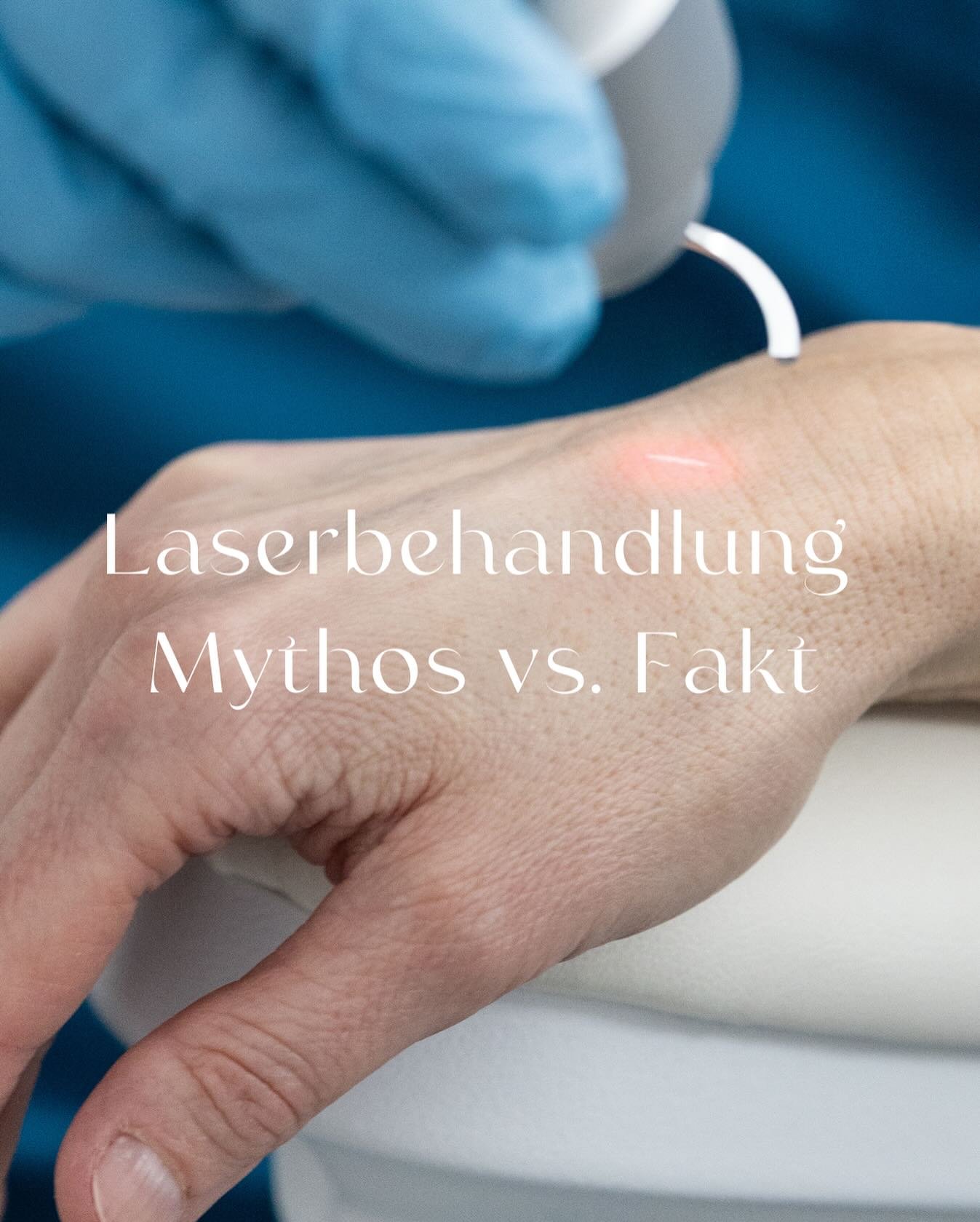 ❌ Mythos: &bdquo;Laserbehandlungen sind schmerzhaft und erfordern eine lange Erholungszeit.&ldquo;

✅ Fakt: Moderne Lasertherapien sind schonend und gut vertr&auml;glich! Dank fortschrittlicher Technologien und Bet&auml;ubungssalben versp&uuml;ren di